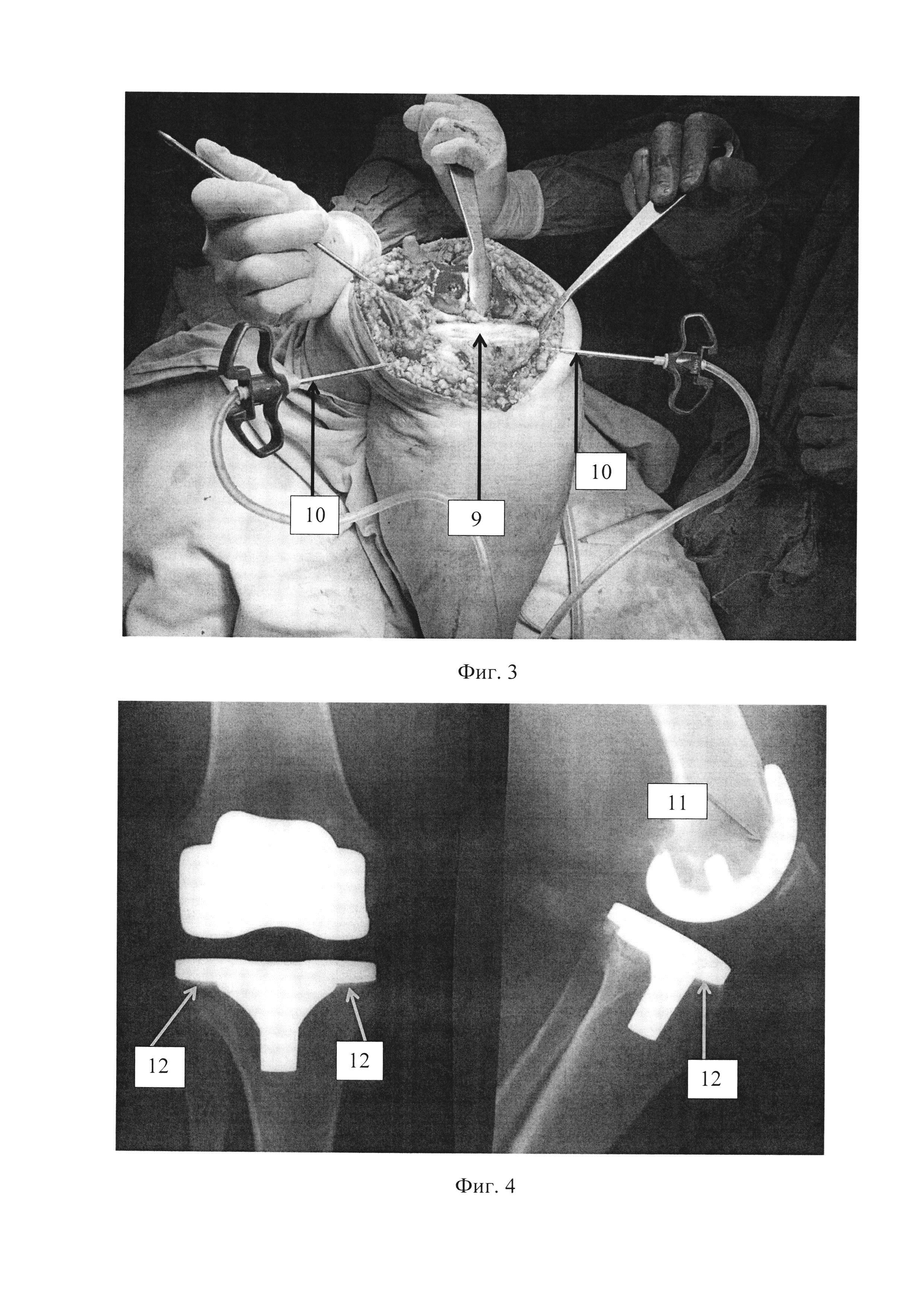 Способ подготовки опилов бедренной и большеберцовой костей при цементной фиксации компонентов эндопротеза коленного сустава