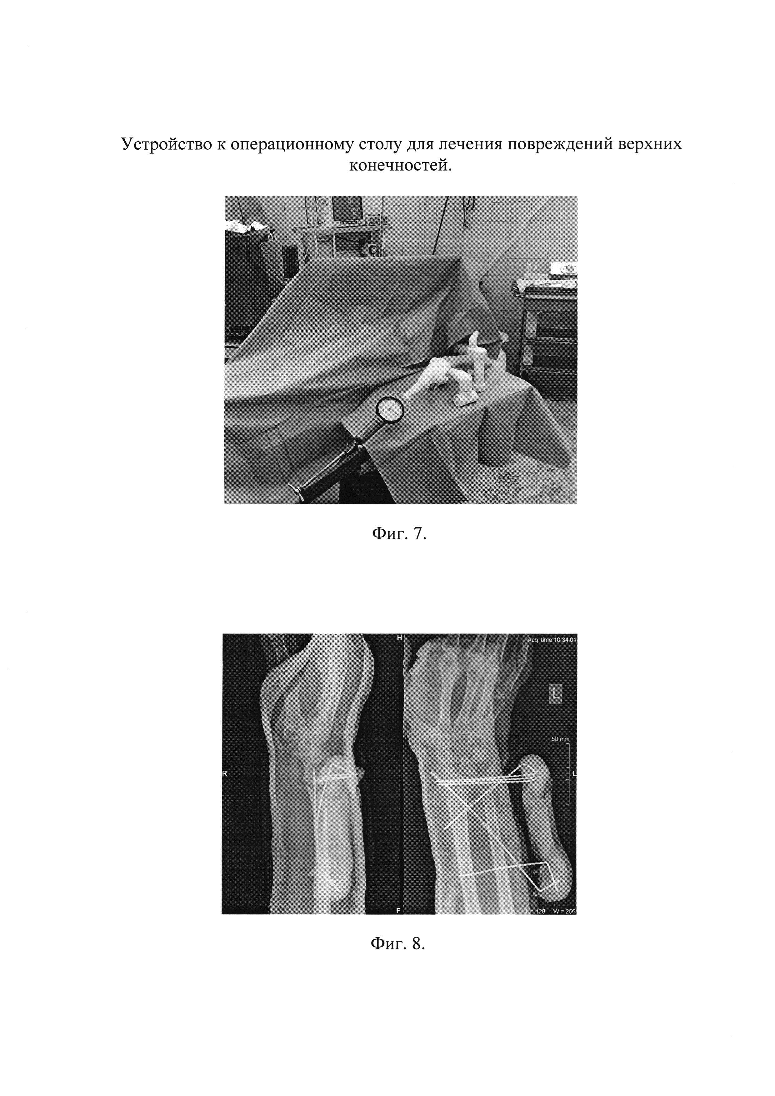 Устройство к операционному столу для лечения повреждений верхних конечностей