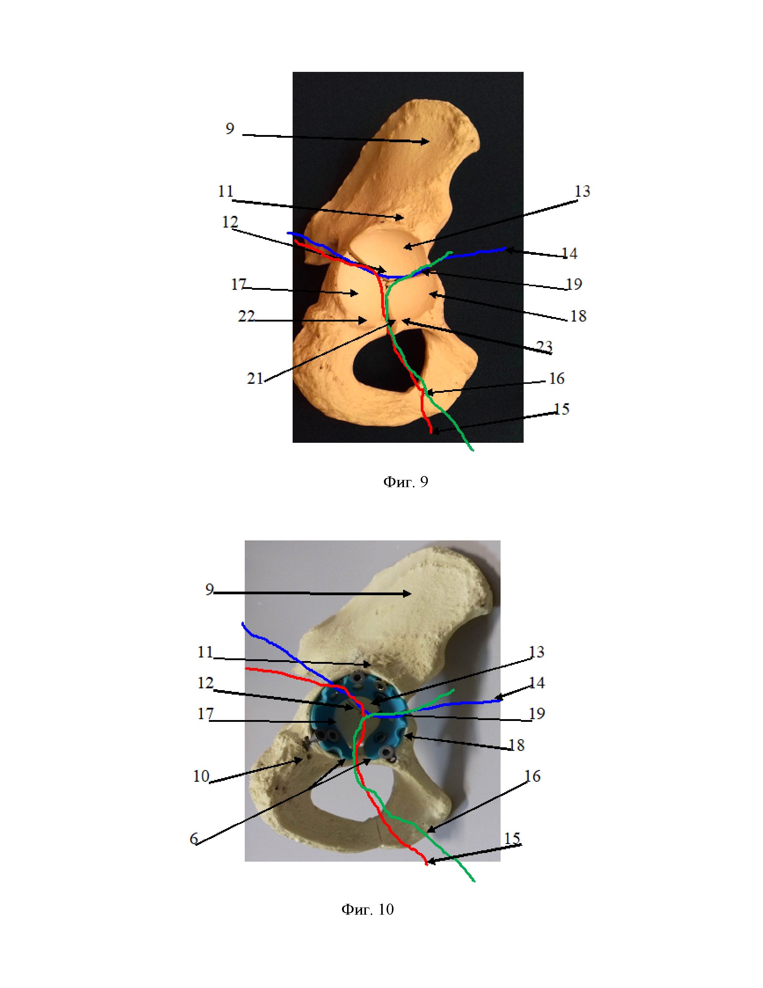 Универсальное репозиционно-фиксационное кольцо с динамической компрессией для оперативного лечения смещенных переломов вертлужной впадины