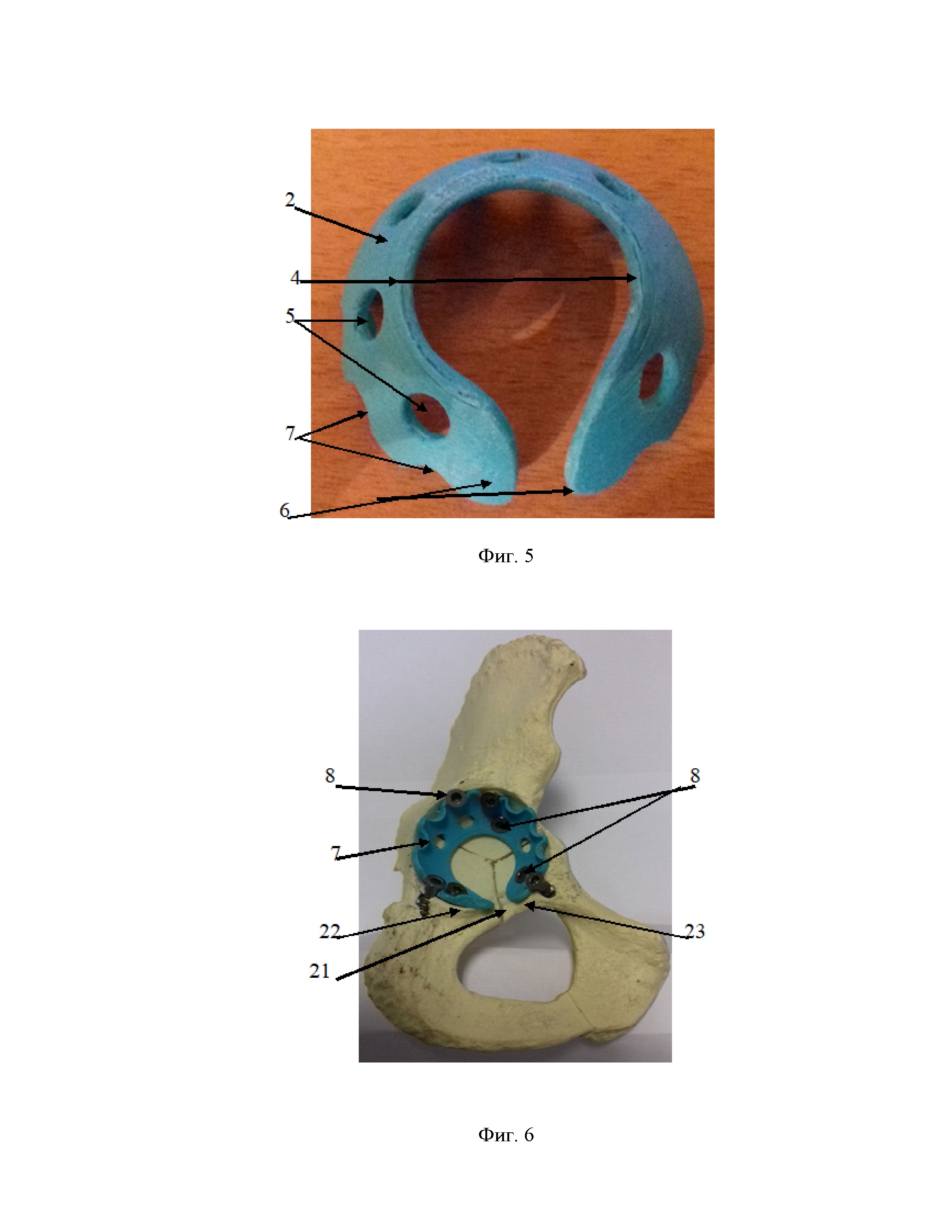 Универсальное репозиционно-фиксационное кольцо с динамической компрессией для оперативного лечения смещенных переломов вертлужной впадины