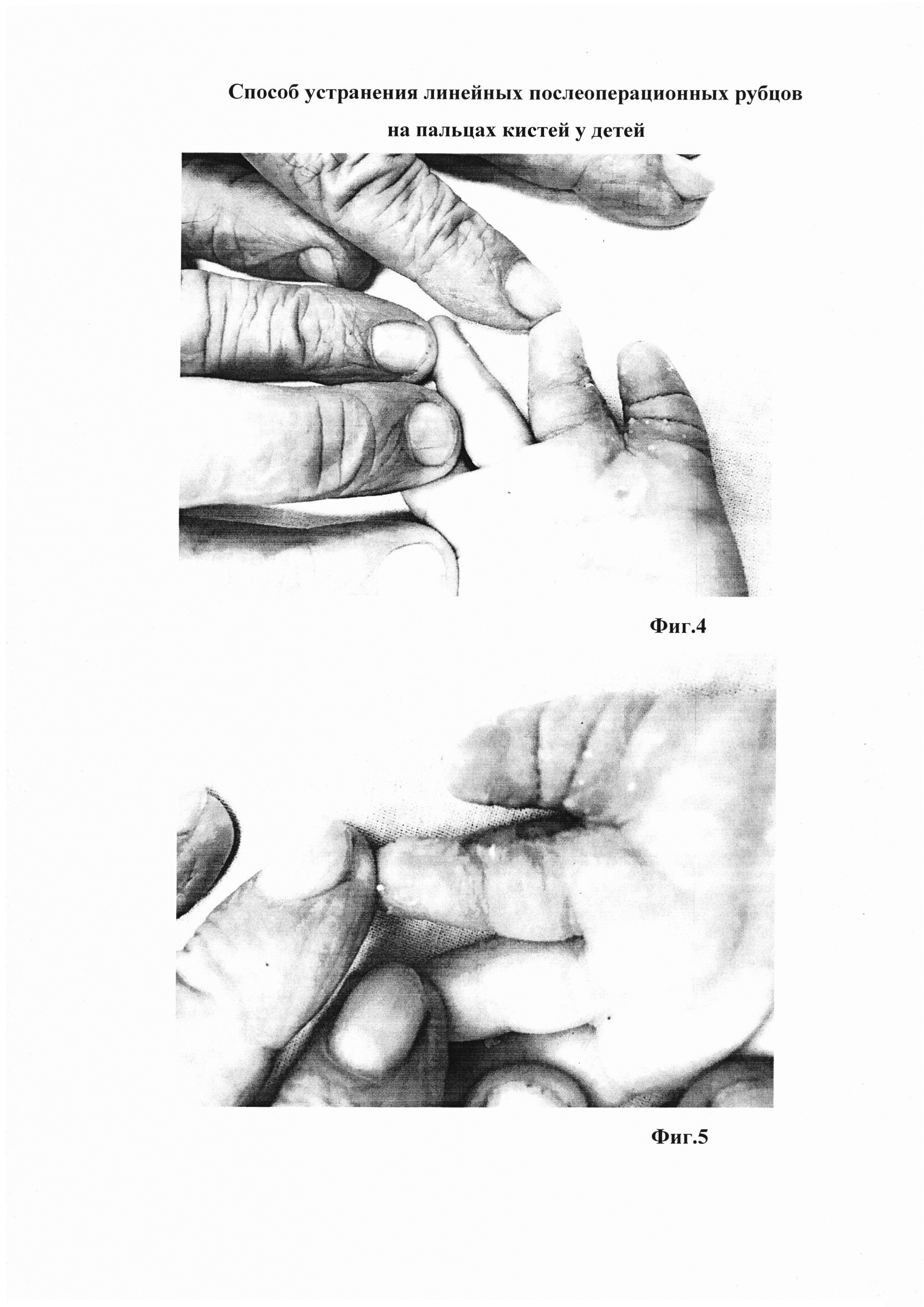 Способ устранения линейных послеоперационных рубцов на пальцах кистей у детей