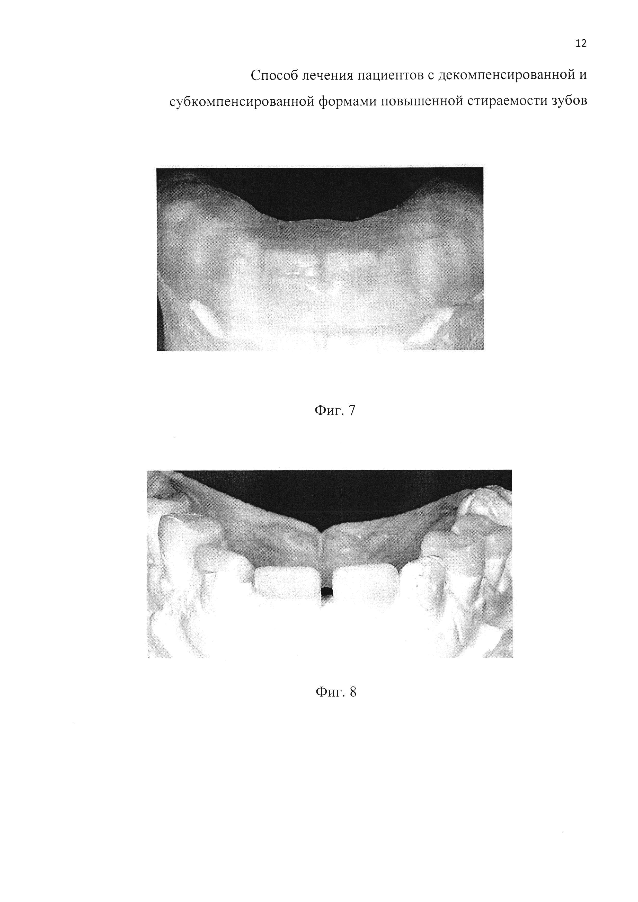 Способ лечения пациентов с декомпенсированной и субкомпенсированной формами повышенной стираемости зубов (варианты)
