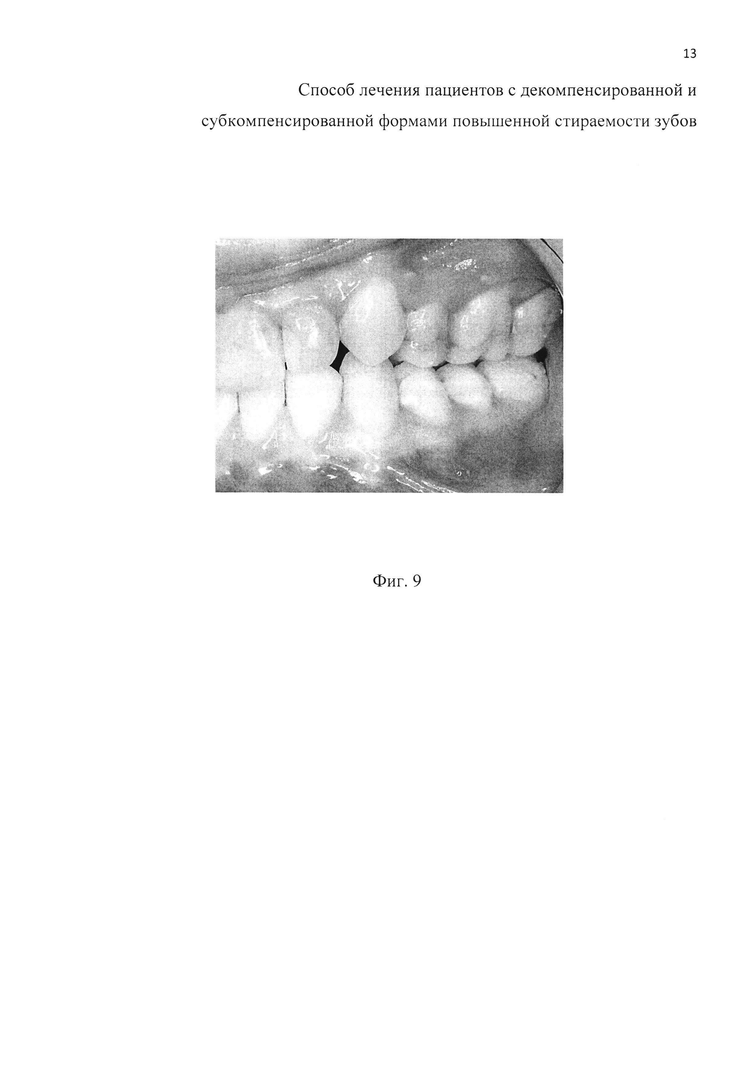 Способ лечения пациентов с декомпенсированной и субкомпенсированной формами повышенной стираемости зубов (варианты)