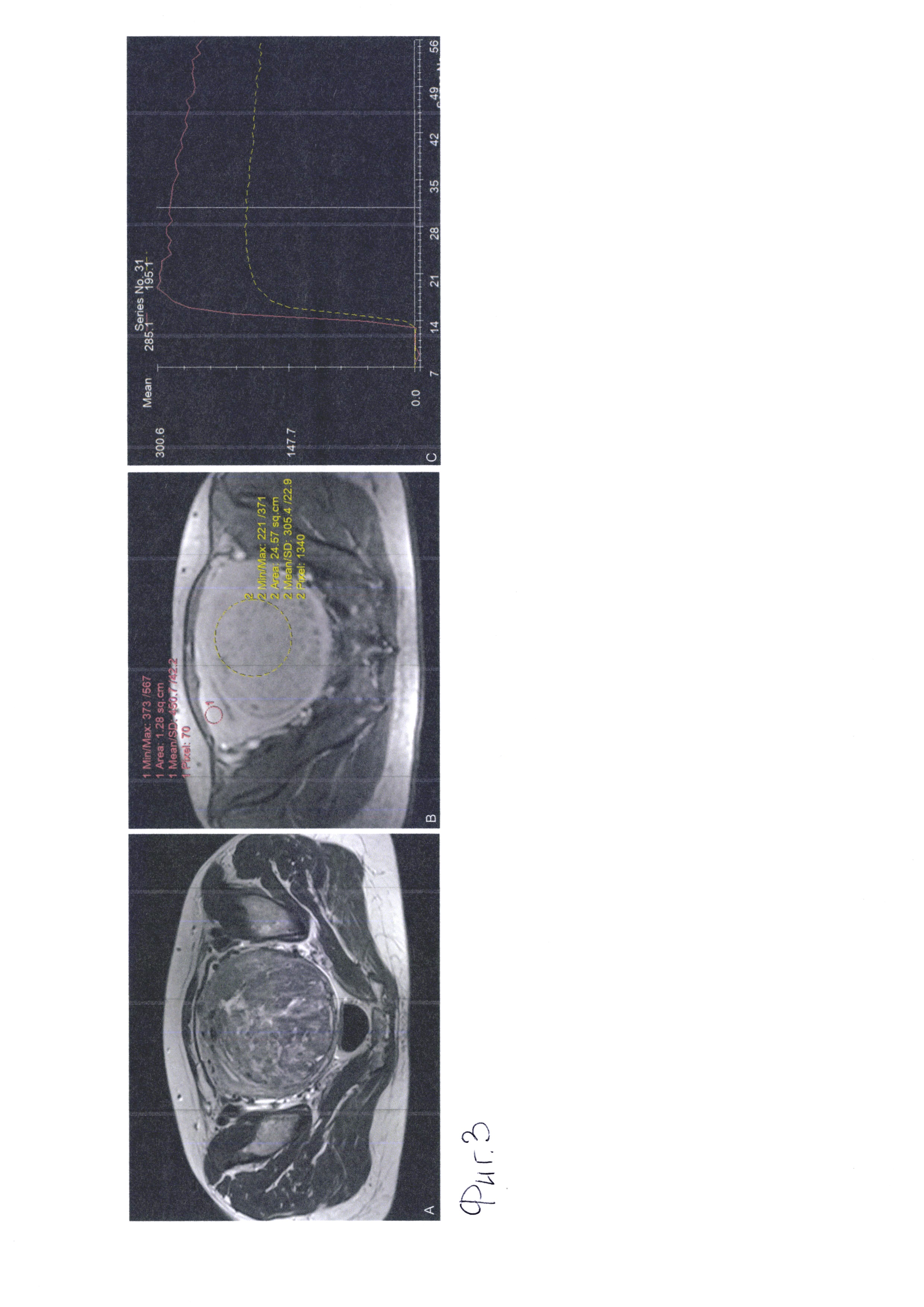 Метод динамического сканирования при мультипараметрической магнитно-резонансной томографии с использованием парамагнитного контрастного агента для определения параметров кровотока в ткани матки при миоме и аденомиозе