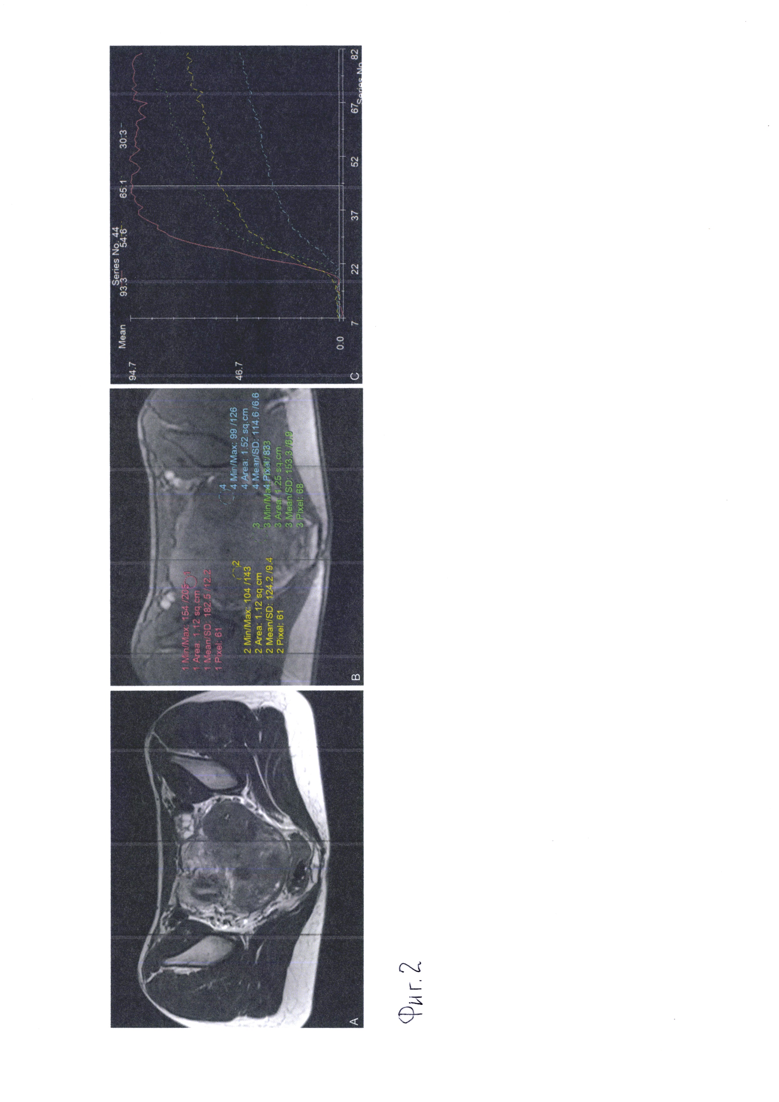 Метод динамического сканирования при мультипараметрической магнитно-резонансной томографии с использованием парамагнитного контрастного агента для определения параметров кровотока в ткани матки при миоме и аденомиозе