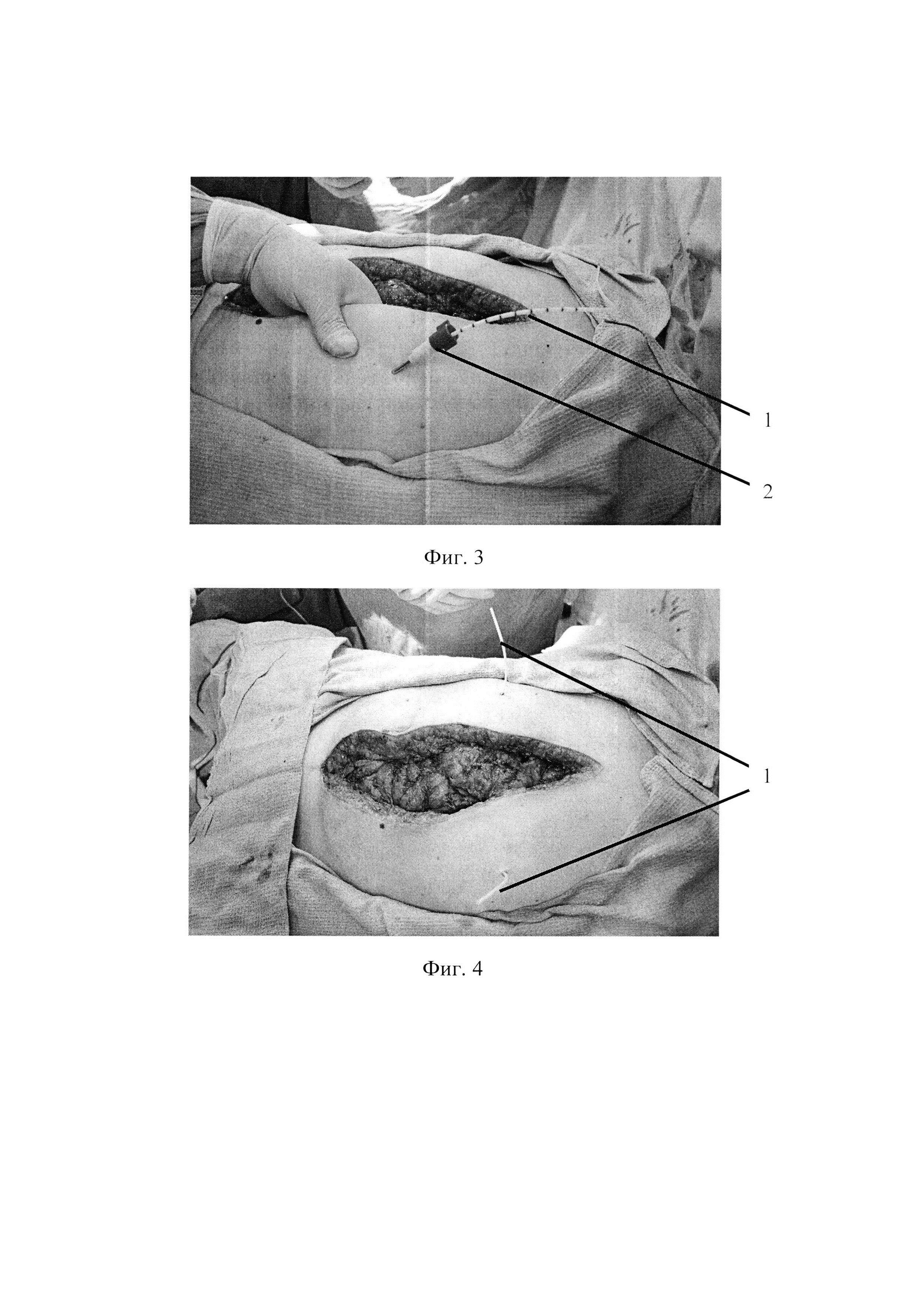 Способ местной сегментарной анестезии в послеоперационном обезболивании лапаротомной раны передней брюшной стенки после неотложных операций у больных острой обтурационной толстокишечной непроходимостью опухолевого генеза