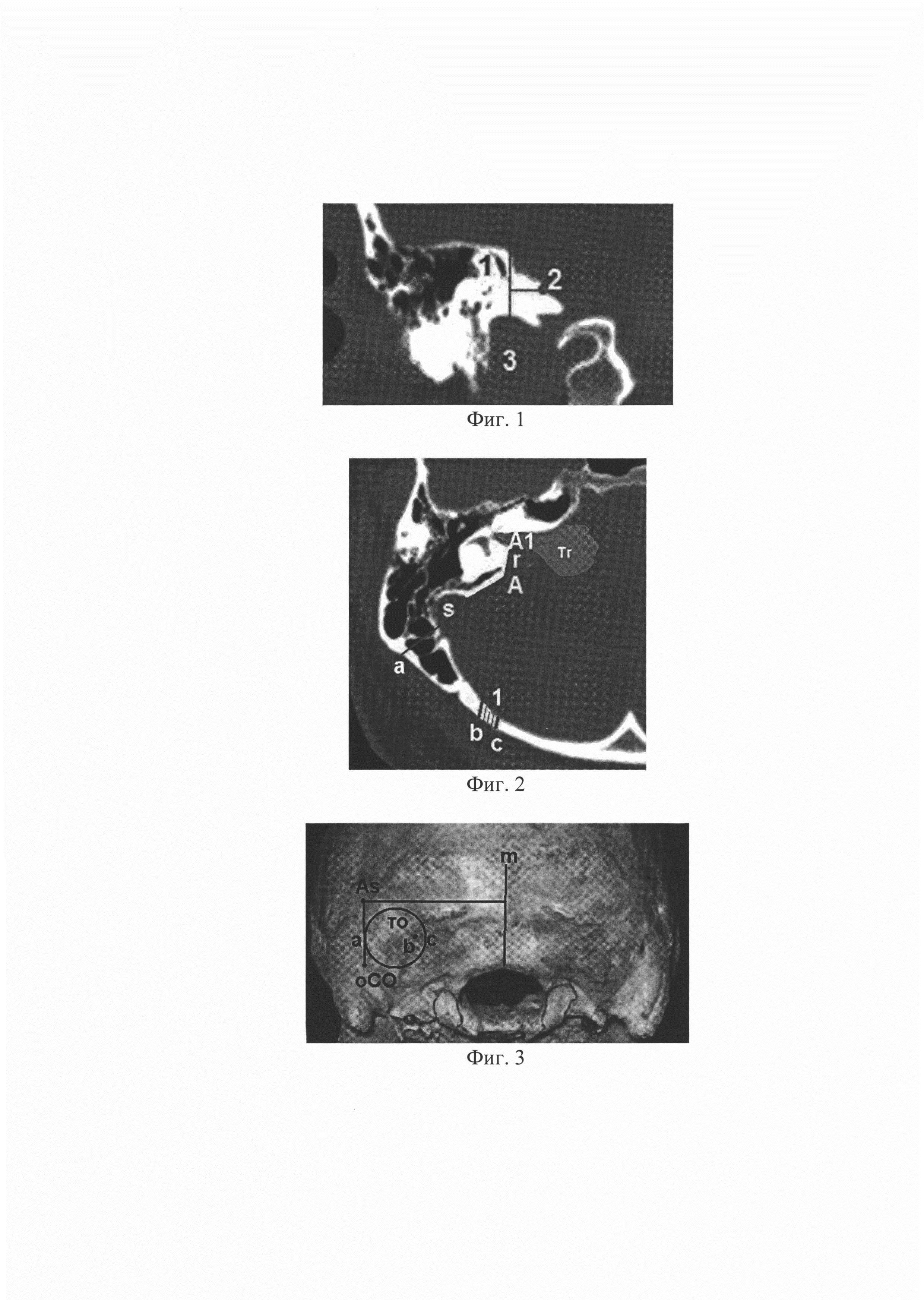 Способ определения границ резекции задней стенки внутреннего слухового канала в хирургии неврином вестибуло-кохлеарного нерва