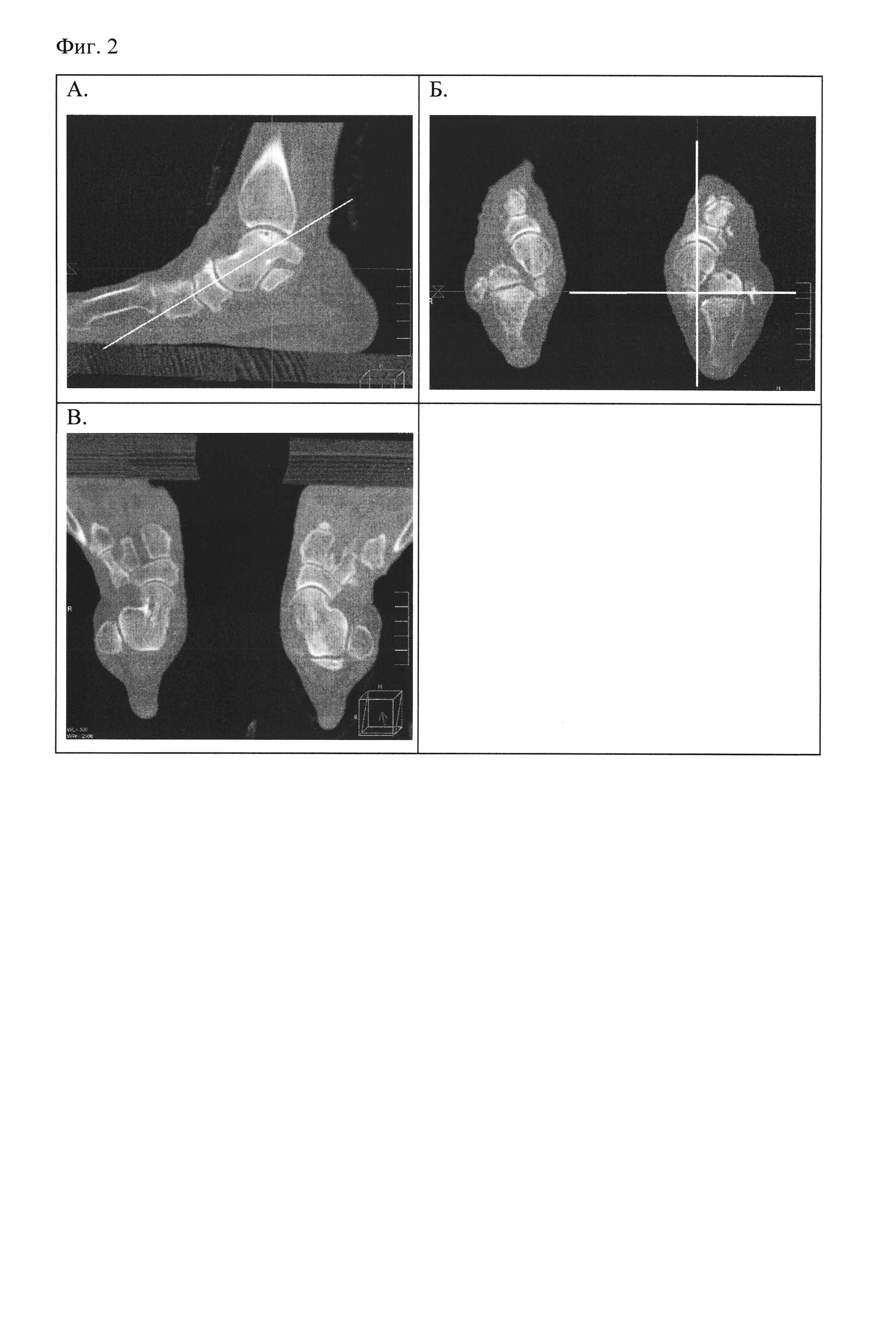 Способ мультиспиральной компьютерно-томографической диагностики заболеваний голеностопного сустава и стопы