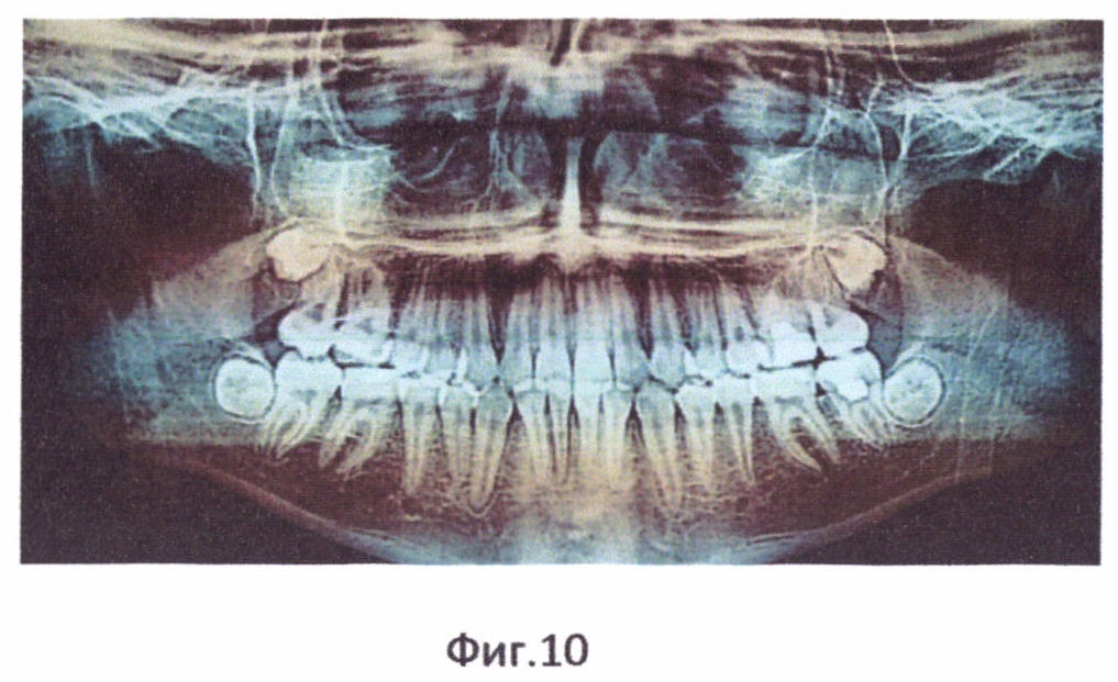 Способ ортодонтического лечения зубочелюстно-лицевых аномалий при помощи брекет-системы
