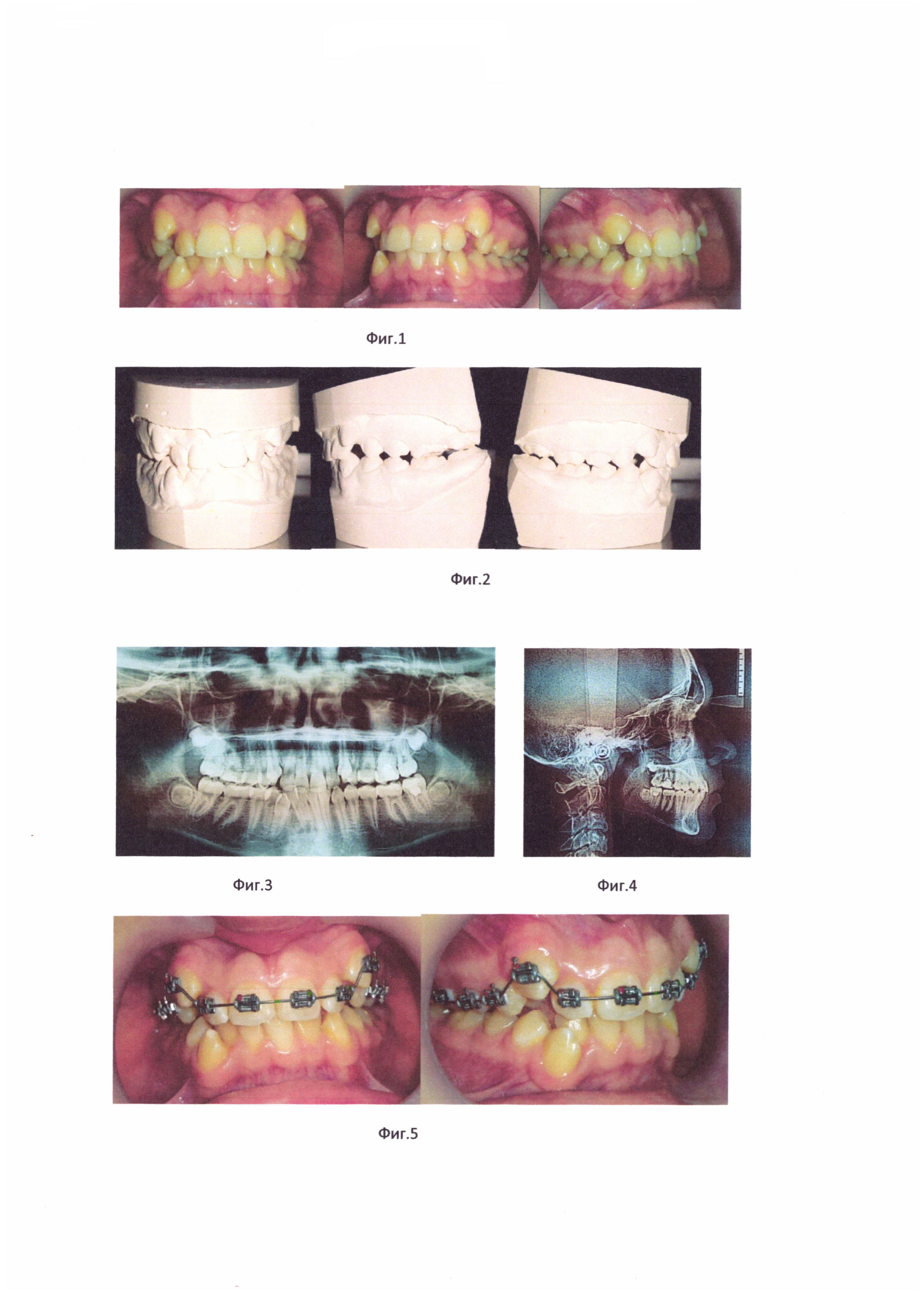 Способ ортодонтического лечения зубочелюстно-лицевых аномалий при помощи брекет-системы