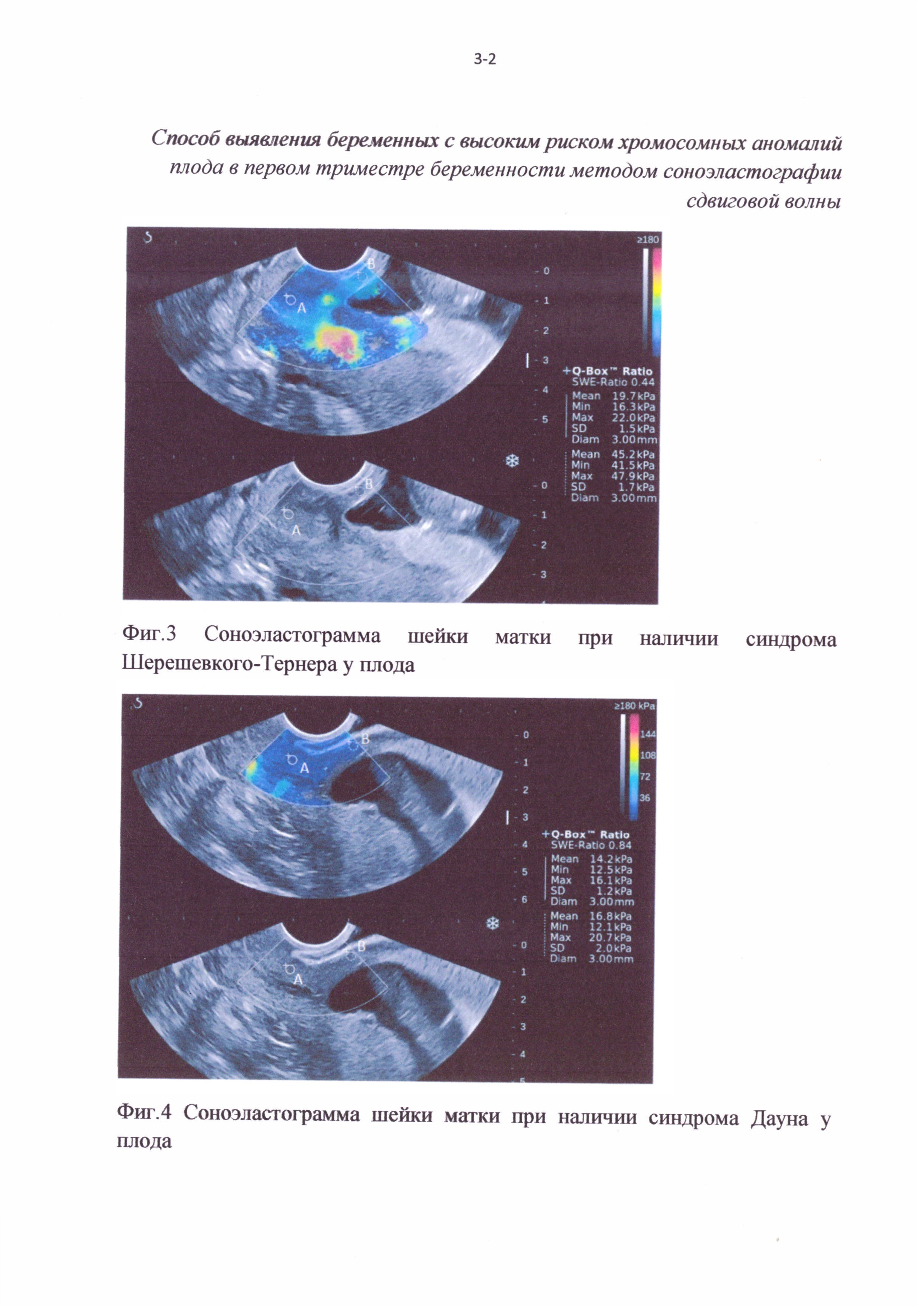 Способ отбора беременных женщин для проведения инвазивной диагностики хромосомных аномалий плода в первом триместре беременности методом соноэластографии сдвиговой волны