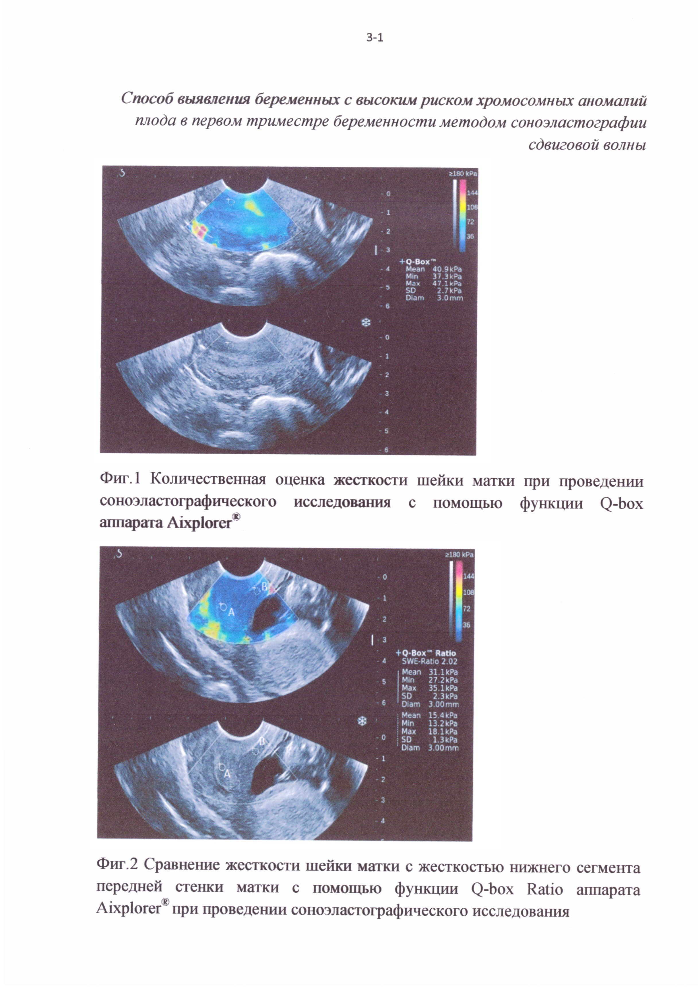 Способ отбора беременных женщин для проведения инвазивной диагностики хромосомных аномалий плода в первом триместре беременности методом соноэластографии сдвиговой волны
