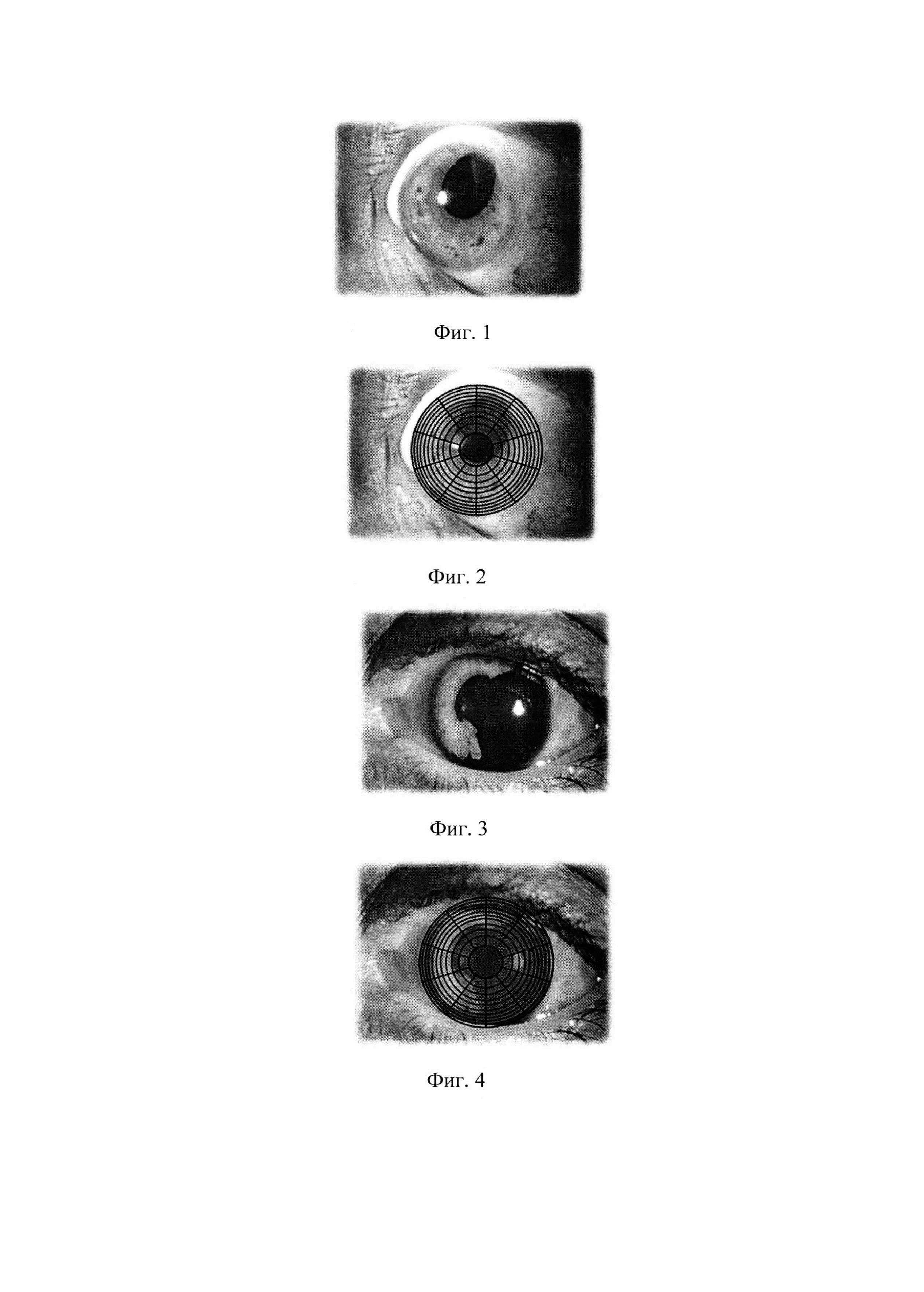 Способ определения площади дефекта радужной оболочки глаза