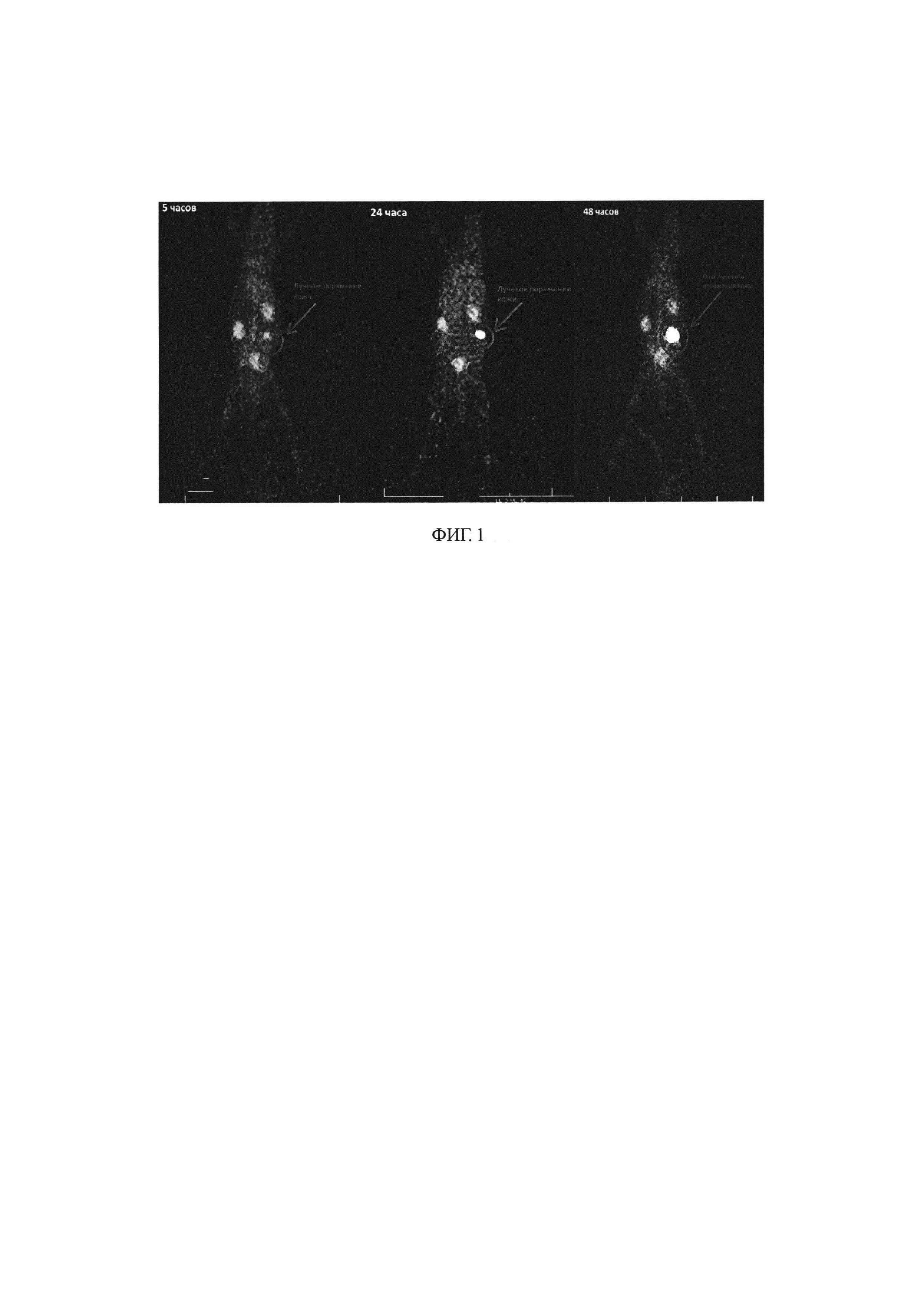 Применение радиофармацевтической композиции с использованием меченых аутологичных лейкоцитов для визуализации местных лучевых поражений методом однофотонной эмиссионной томографии