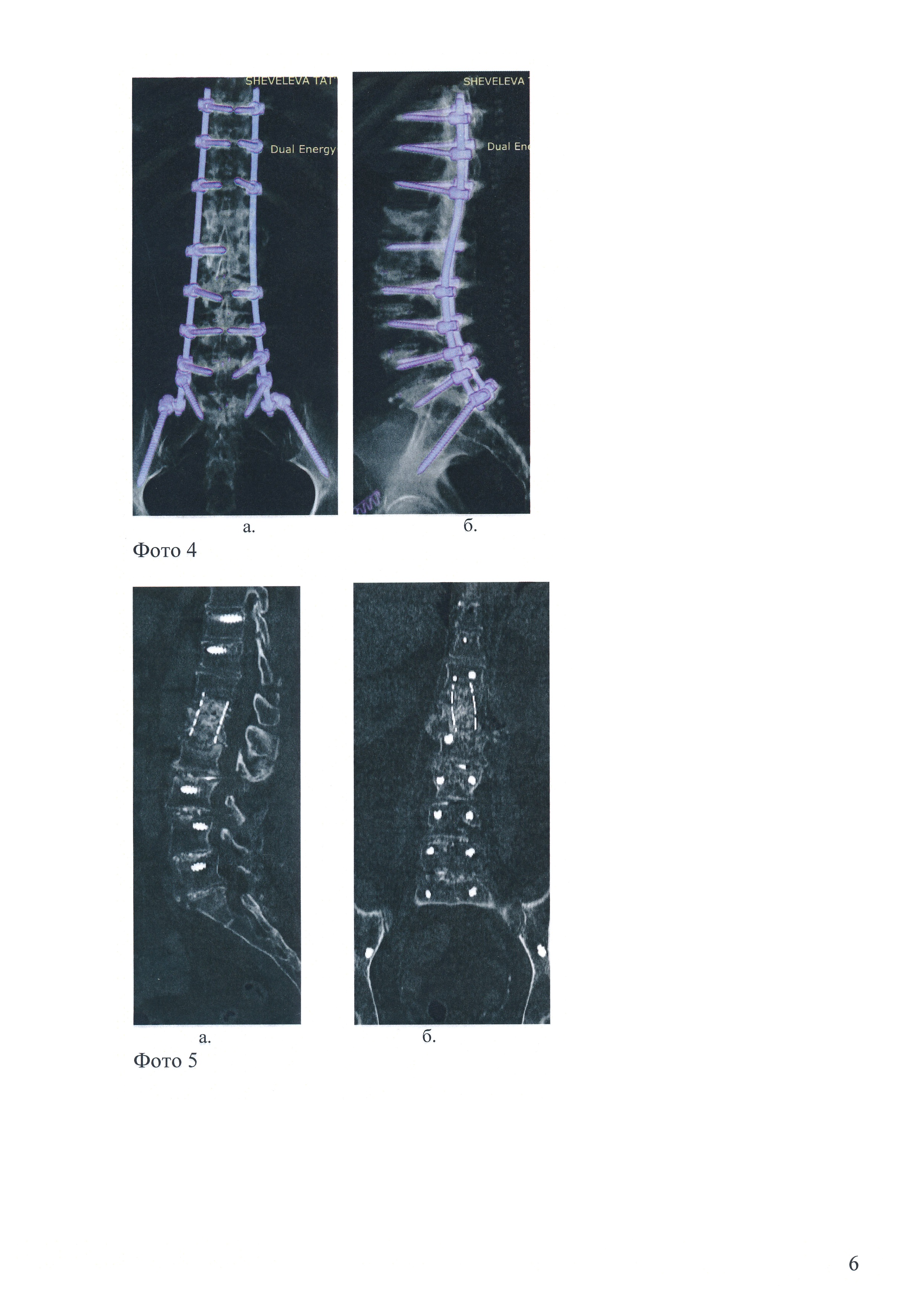 Способ профилактики переломов смежных позвонков при транспедикулярной фиксации на фоне остеопороза