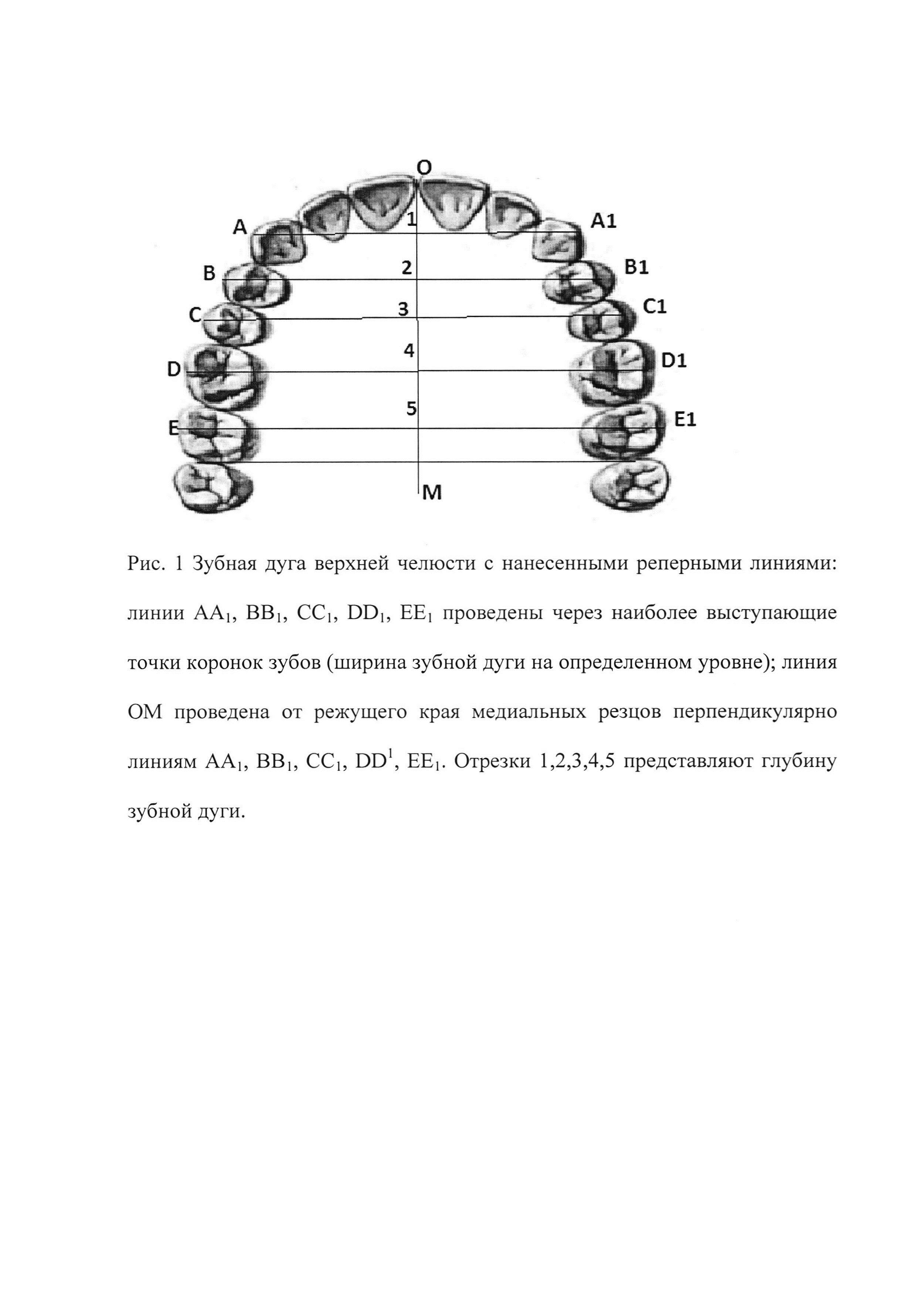 Способ расчета длины зубной дуги верхней челюсти