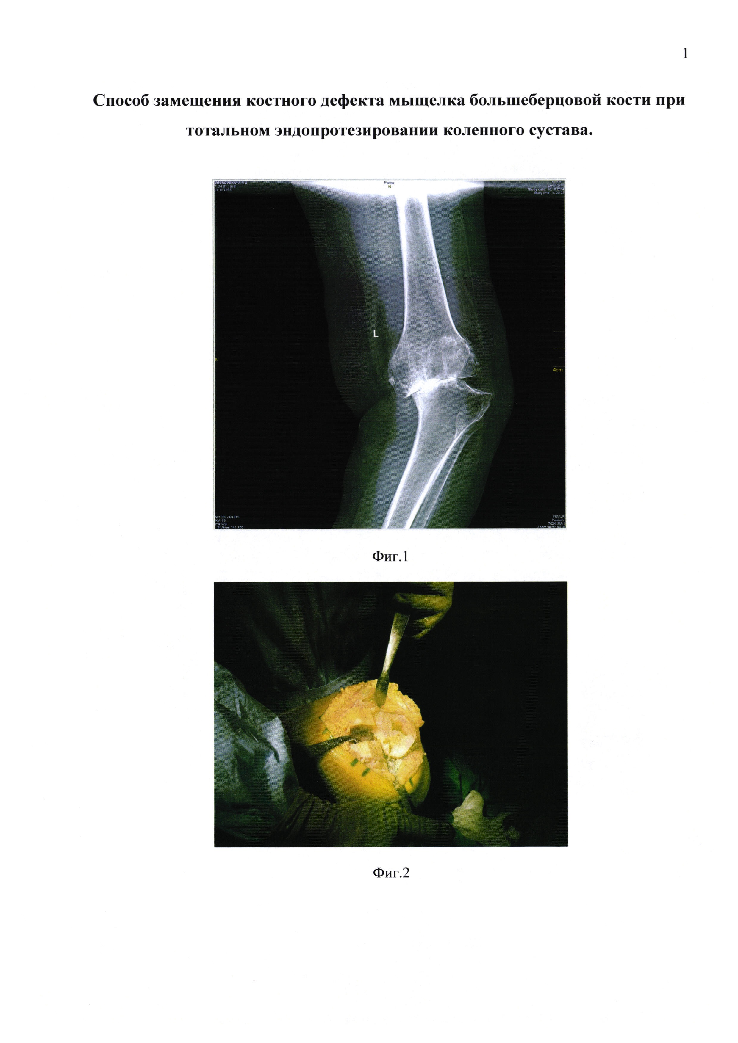 Способ замещения костного дефекта мыщелка большеберцовой кости при тотальном эндопротезировании коленного сустава