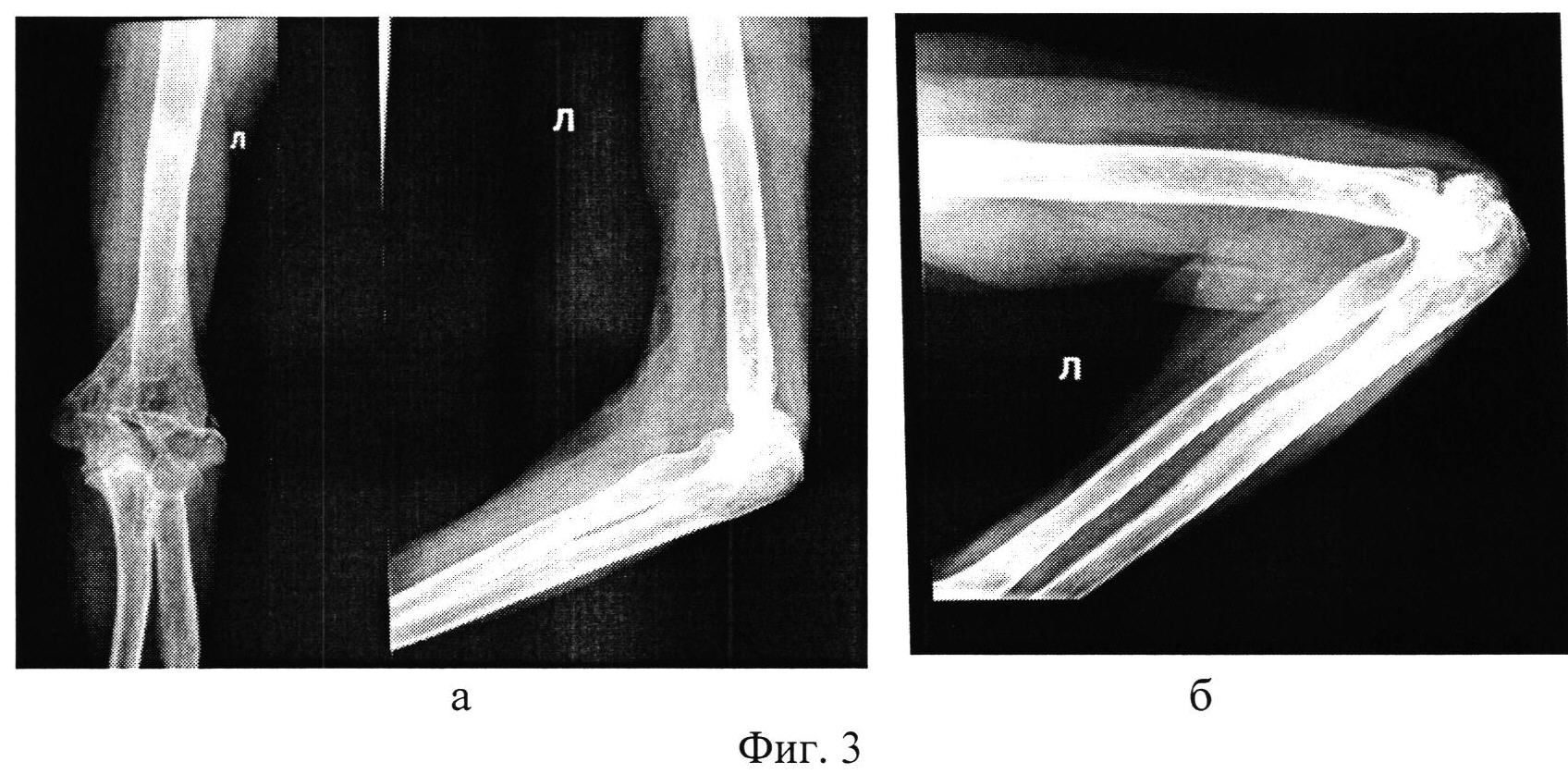 Контрактура локтевого сустава на рентгене