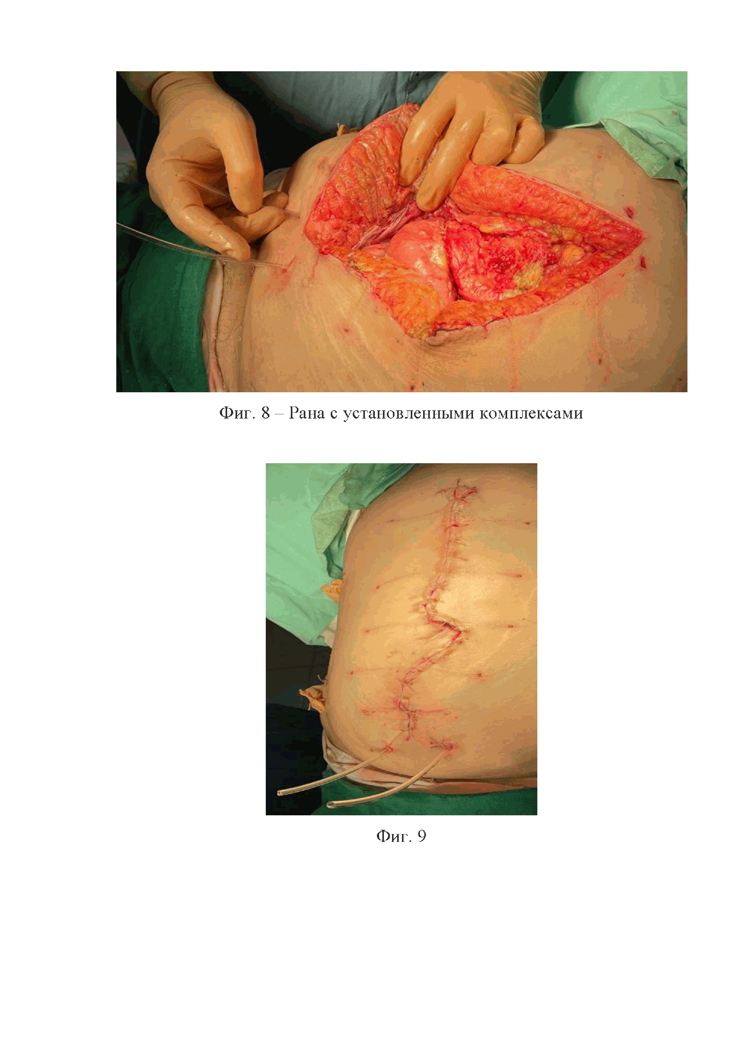 Способ местной анестезии срединной лапаротомной раны с использованием полупроницаемых мембран
