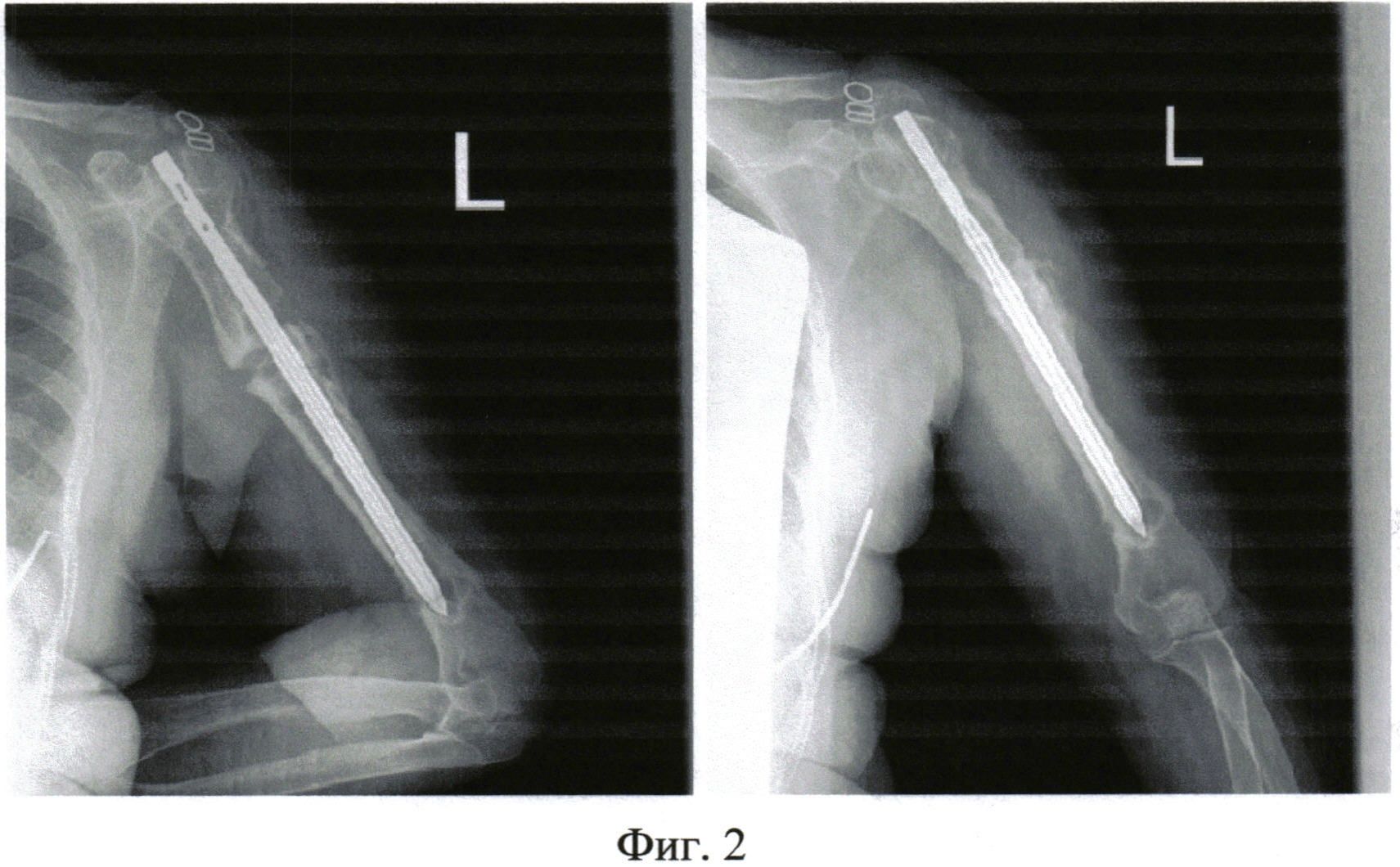 Ложный сустав плечевой кости мкб 10