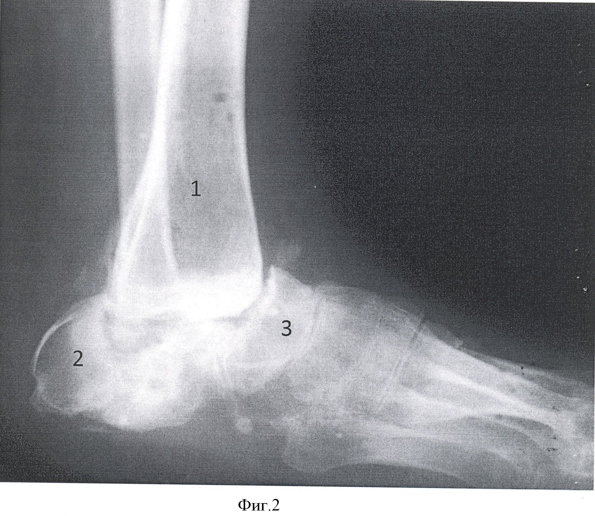 Остеомиелит голеностопного сустава рентген