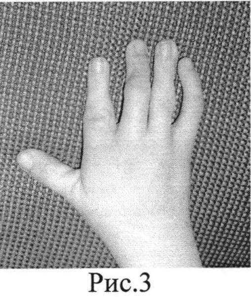 Сгибательная контрактура сустава. Сгибательная контрактура пальца. Сгибательная контрактура пальцев кисти. Контрактура Дюпюитрена. Сгибательная контрактура пальцев кисти у ребенка.