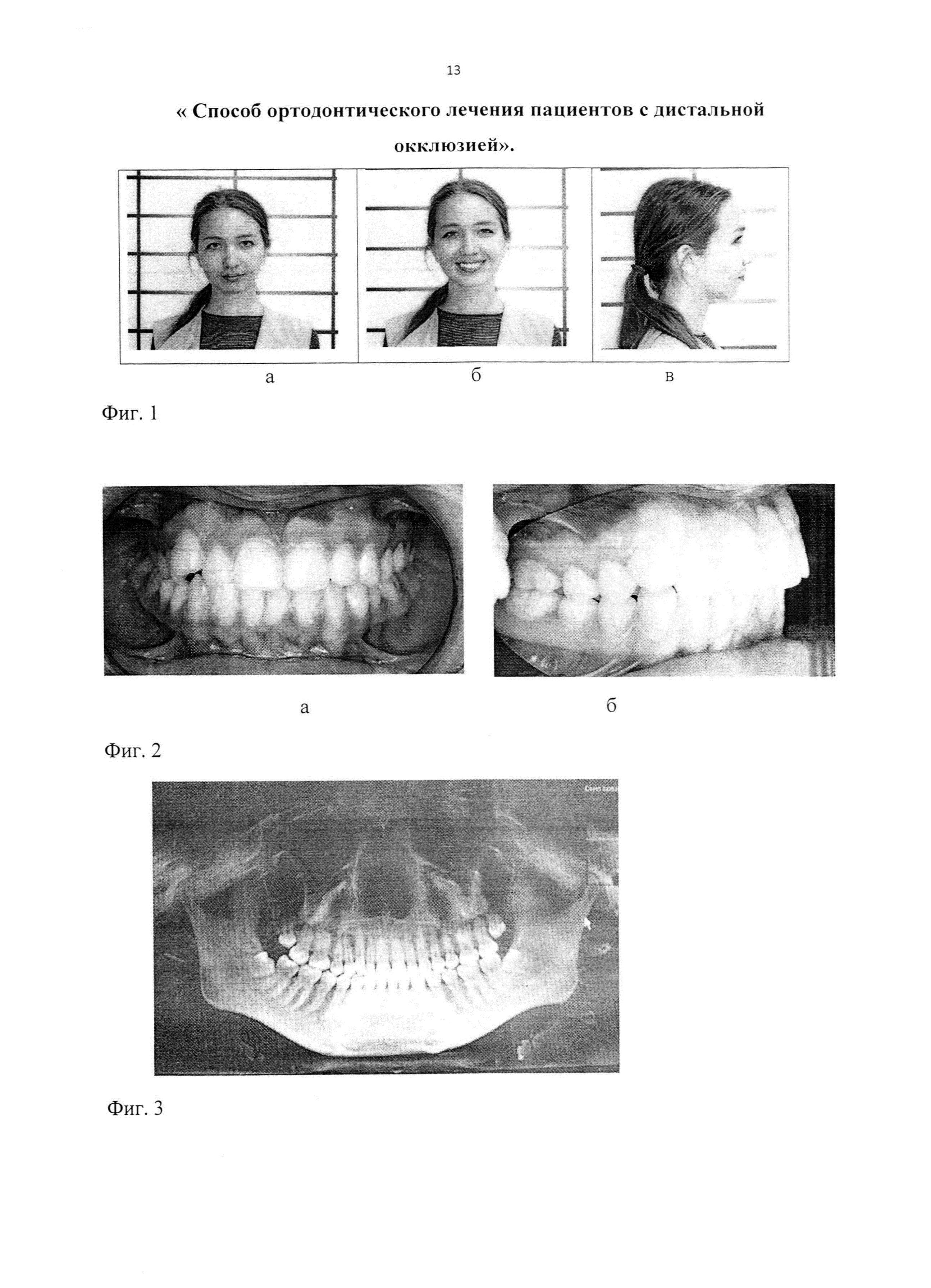Способ ортодонтического лечения пациентов с дистальной окклюзией