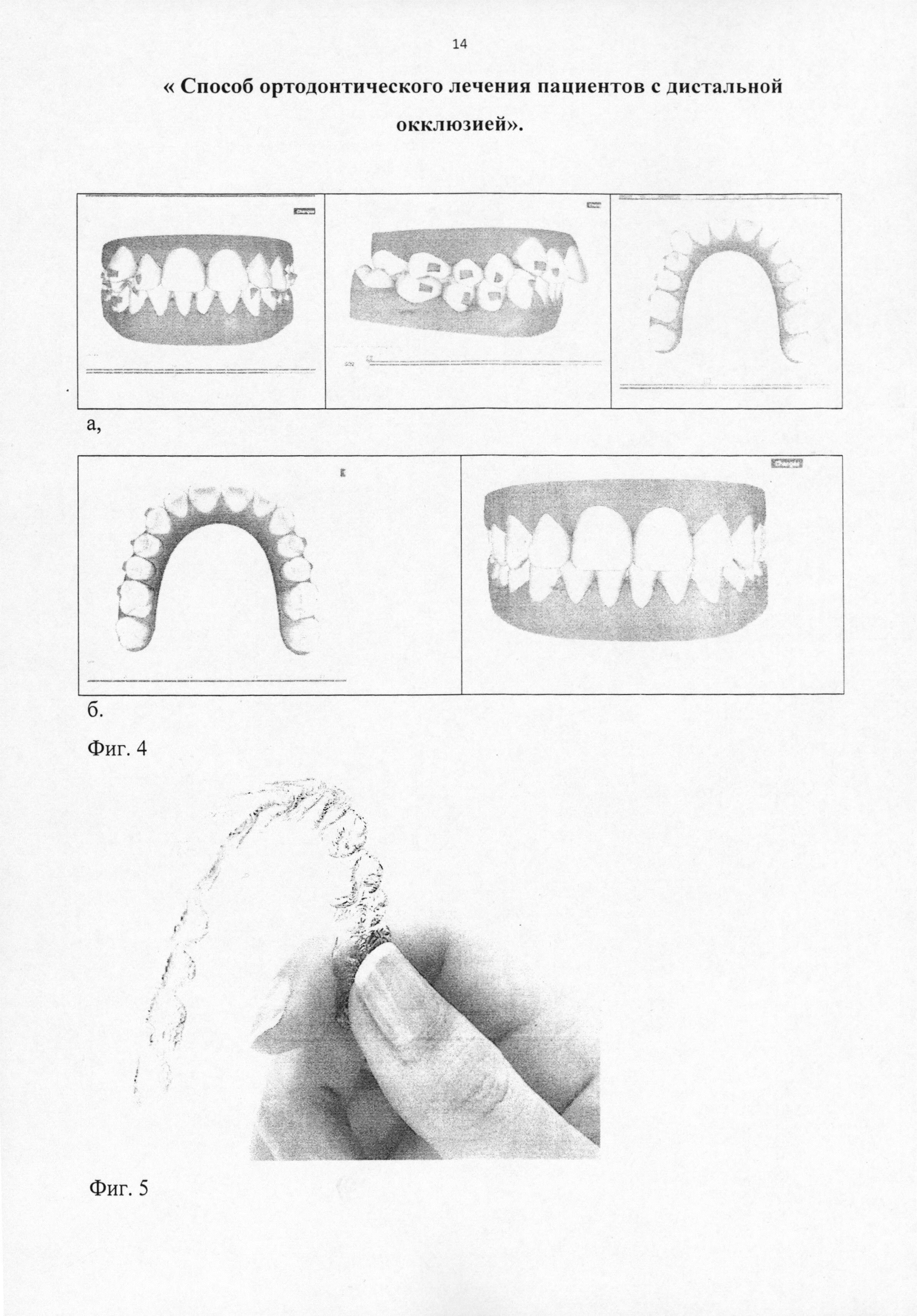 Способ ортодонтического лечения пациентов с дистальной окклюзией