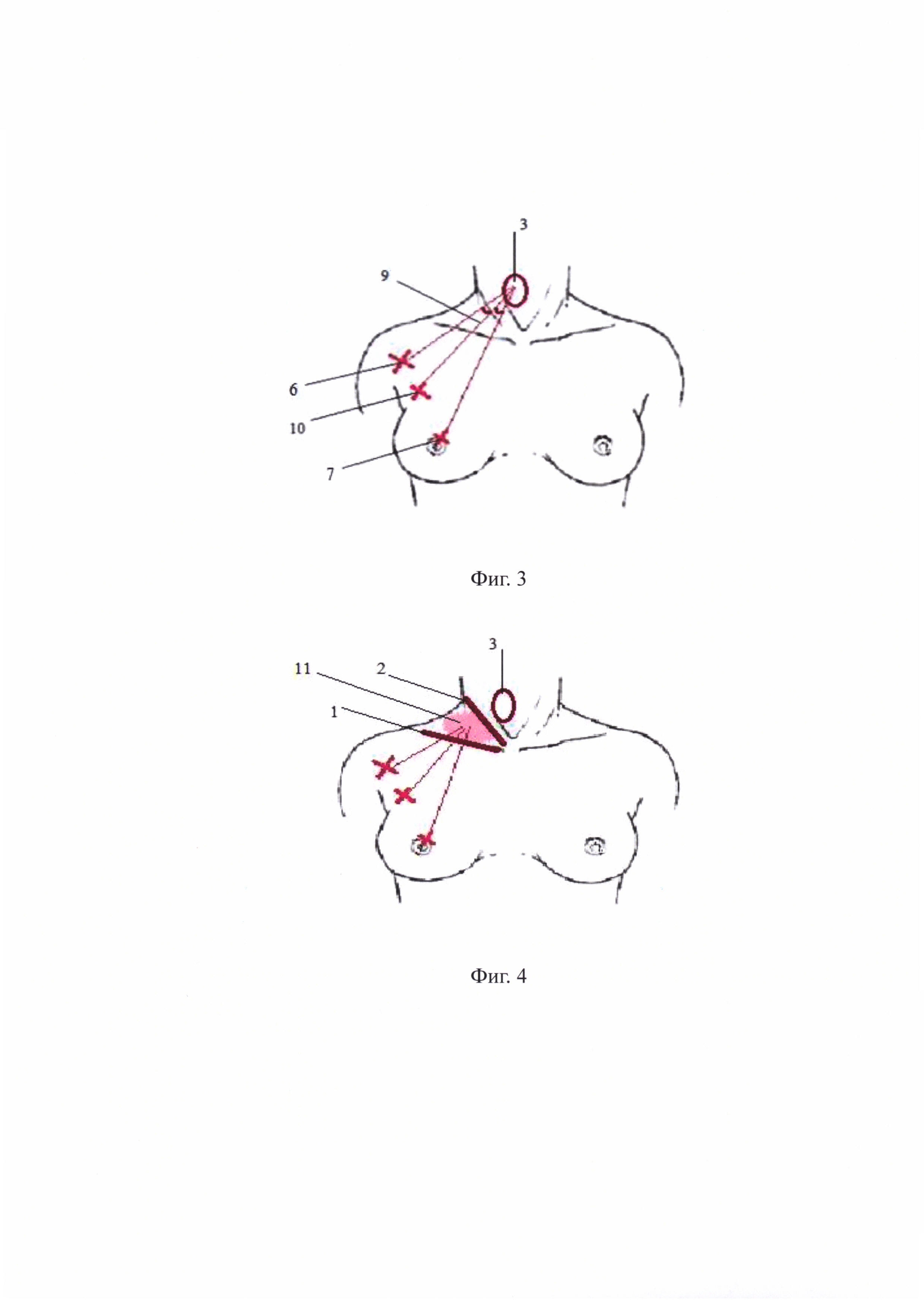 Способ эндовидеохирургического доступа к доле щитовидной железы