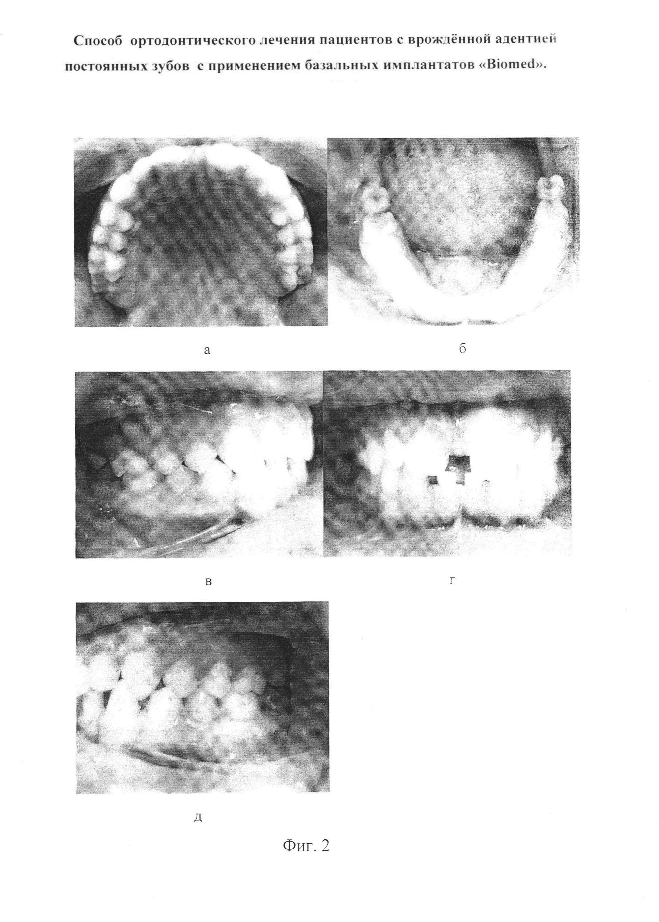 Способ ортодонтического лечения пациентов с врождённой адентией постоянных зубов с применением базальных имплантатов 
