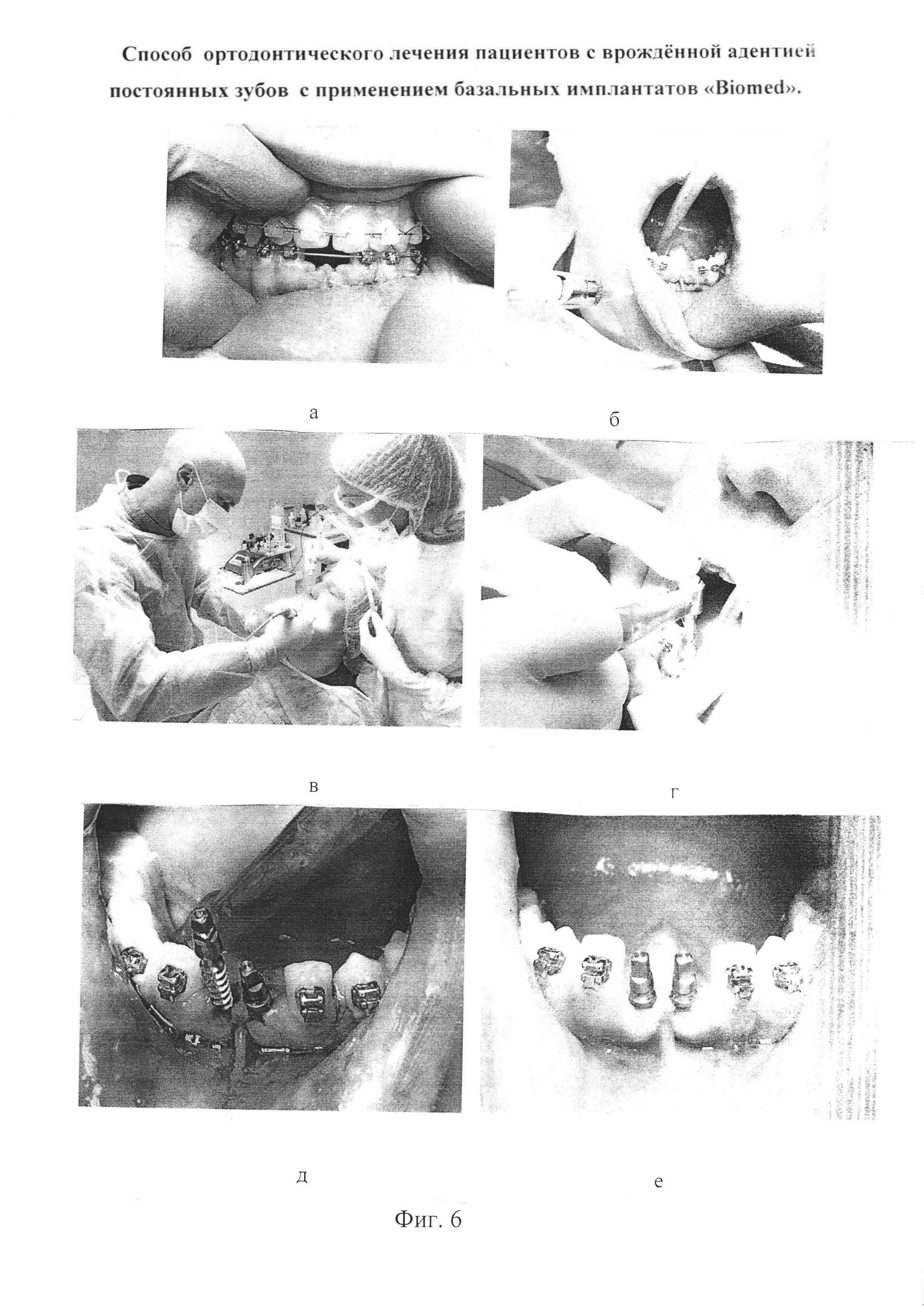 Способ ортодонтического лечения пациентов с врождённой адентией постоянных зубов с применением базальных имплантатов 