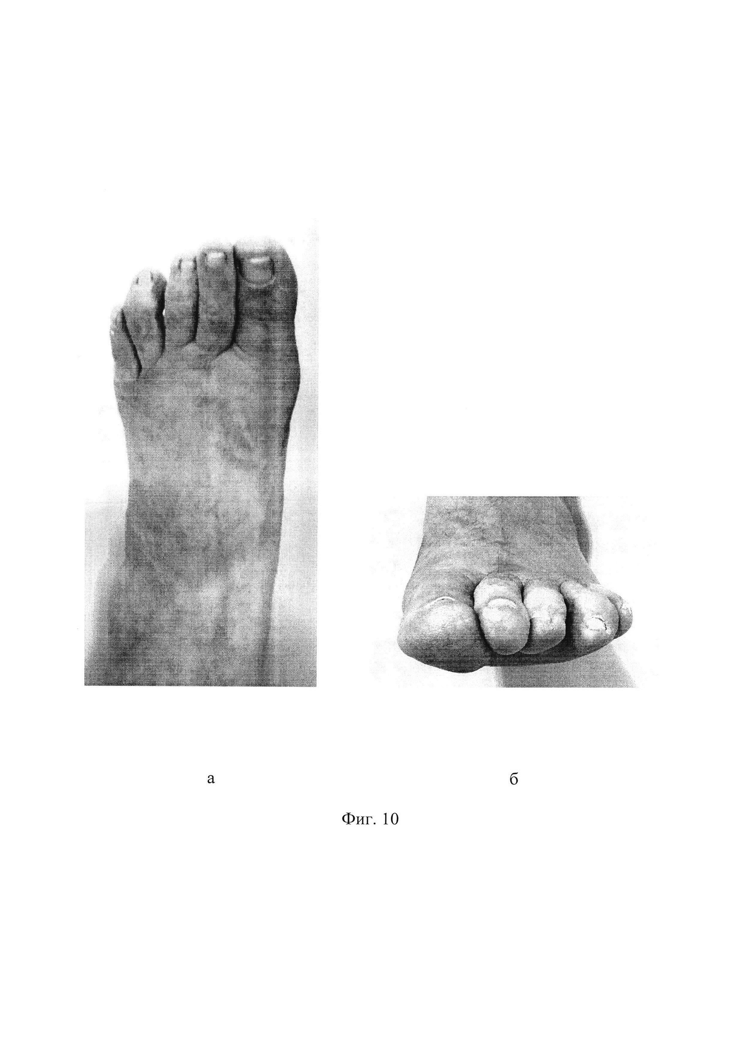 Способ хирургического лечения деформации пальцев стопы