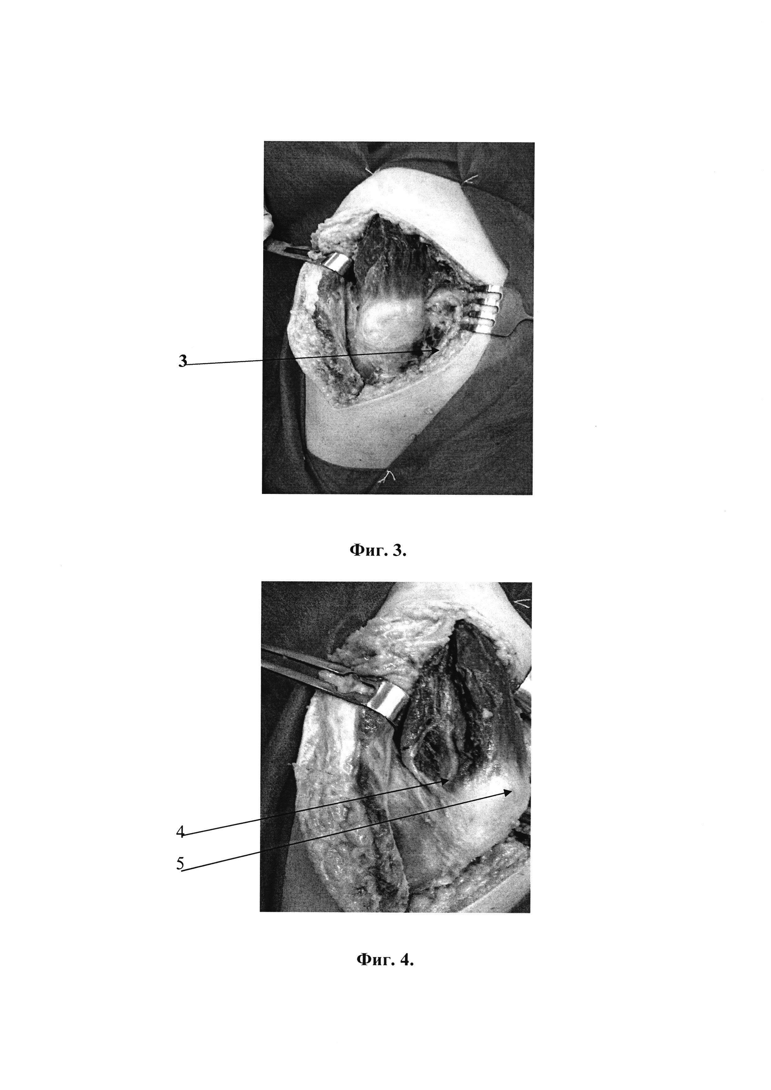 Способ экспериментального хирургического доступа к тазобедренному суставу при чрезвертлужных переломах костей таза