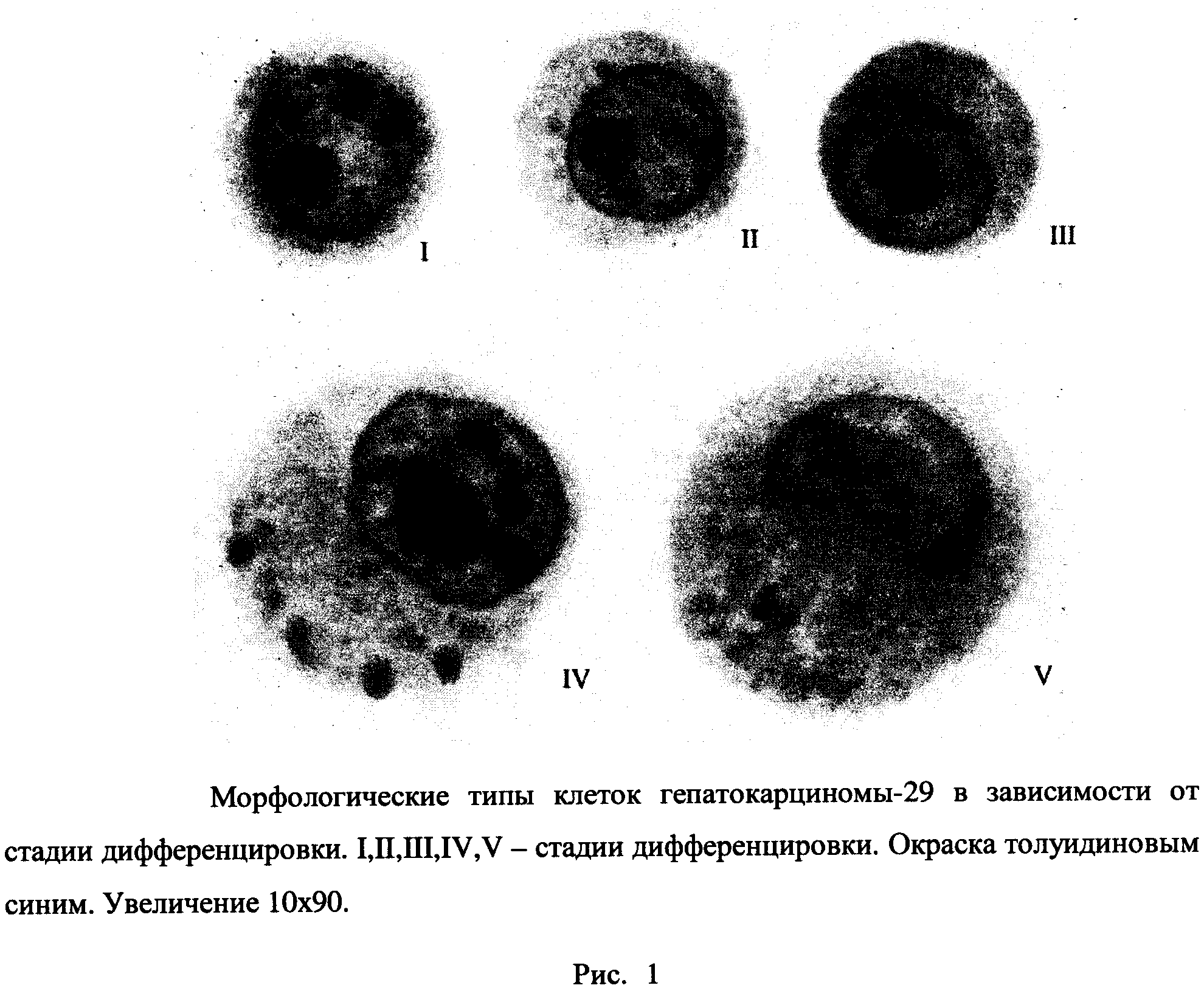 Степени дифференцировки опухолей. Степень дифференцировки злокачественной опухоли. Дифференцировка клеток в злокачественных опухолях. Гепатокарцинома анализ крови.