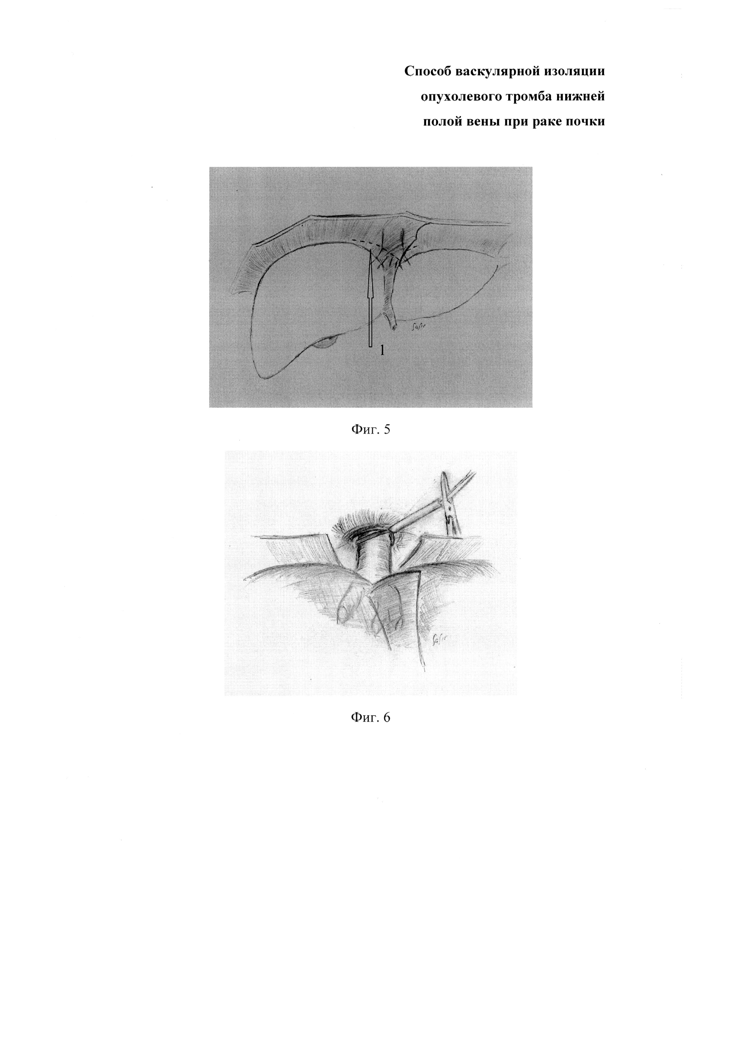 Способ васкулярной изоляции опухолевого тромба нижней полой вены при раке почки