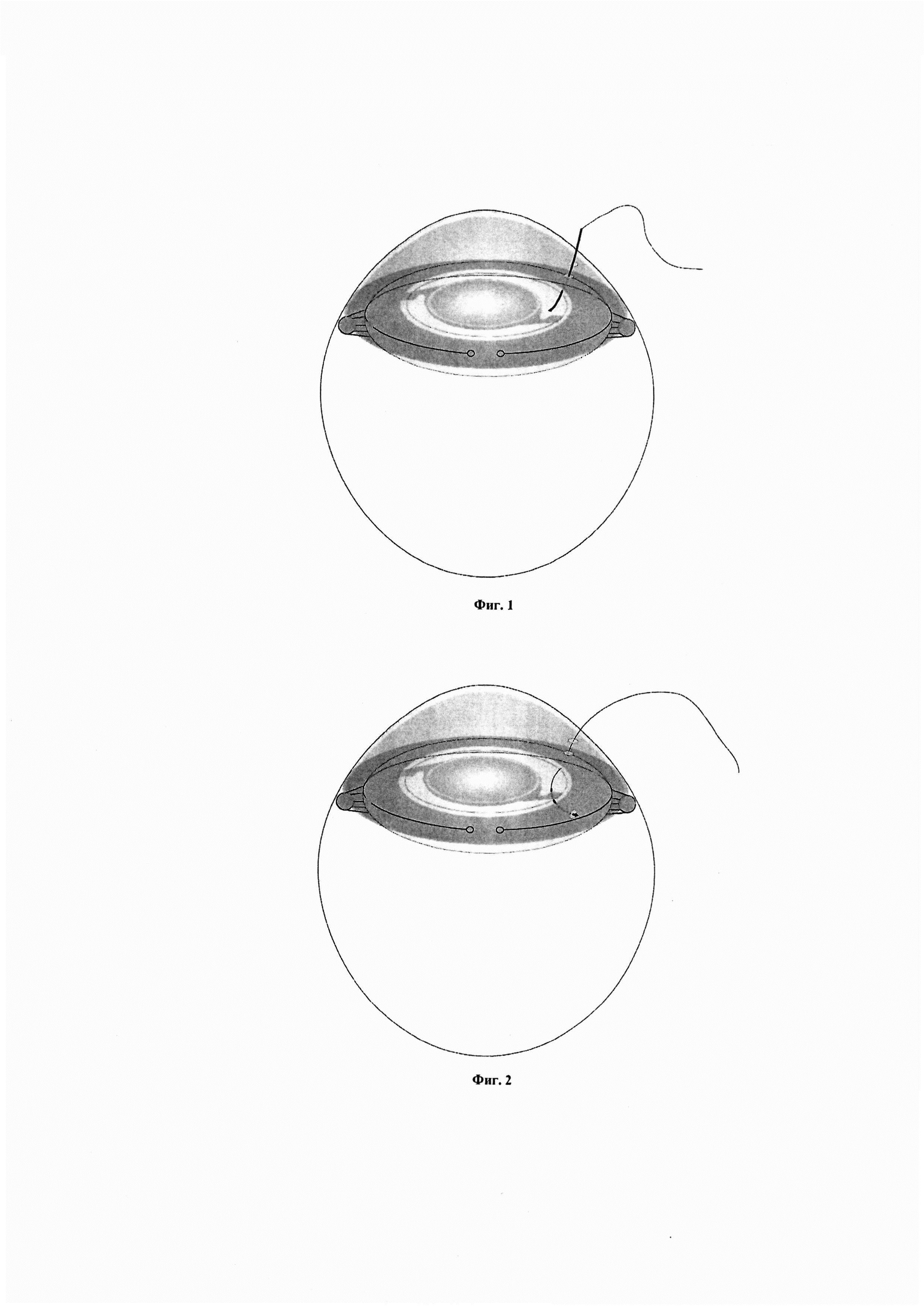 Способ иридо-капсулярной фиксации интраокулярной линзы в ходе фемтолазер-ассистированной экстракции катаракты, осложненной подвывихом хрусталика (Варианты)