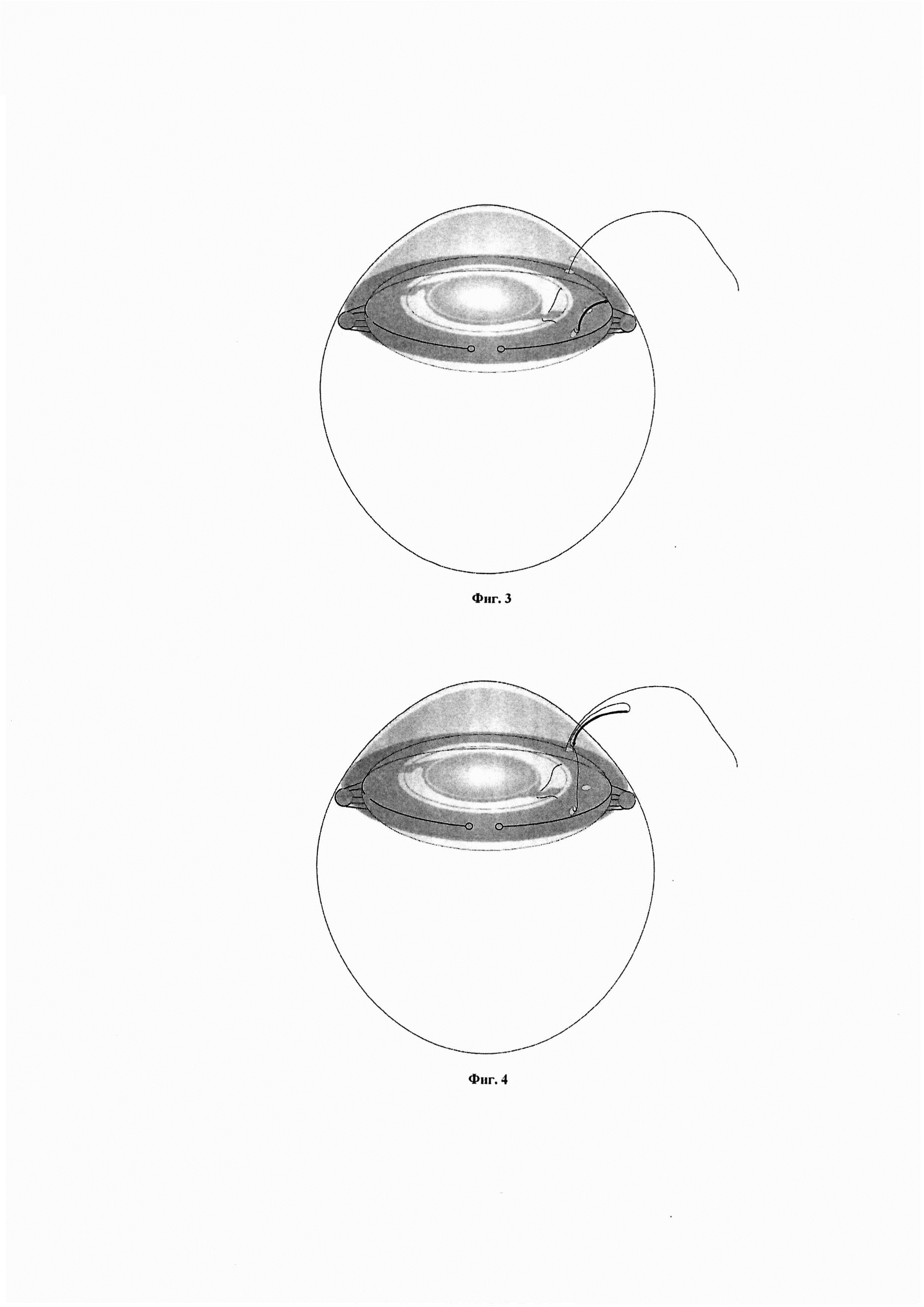 Способ иридо-капсулярной фиксации интраокулярной линзы в ходе фемтолазер-ассистированной экстракции катаракты, осложненной подвывихом хрусталика (Варианты)