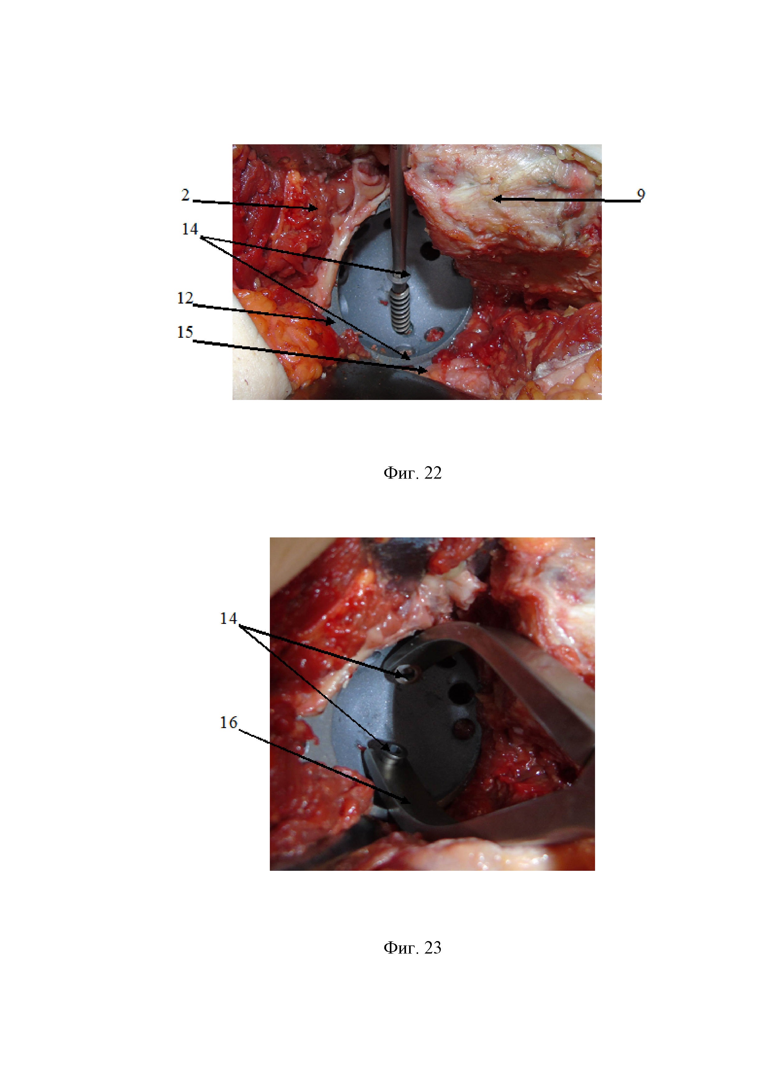 Способ открытой репозиции и фиксации переломов вертлужной впадины