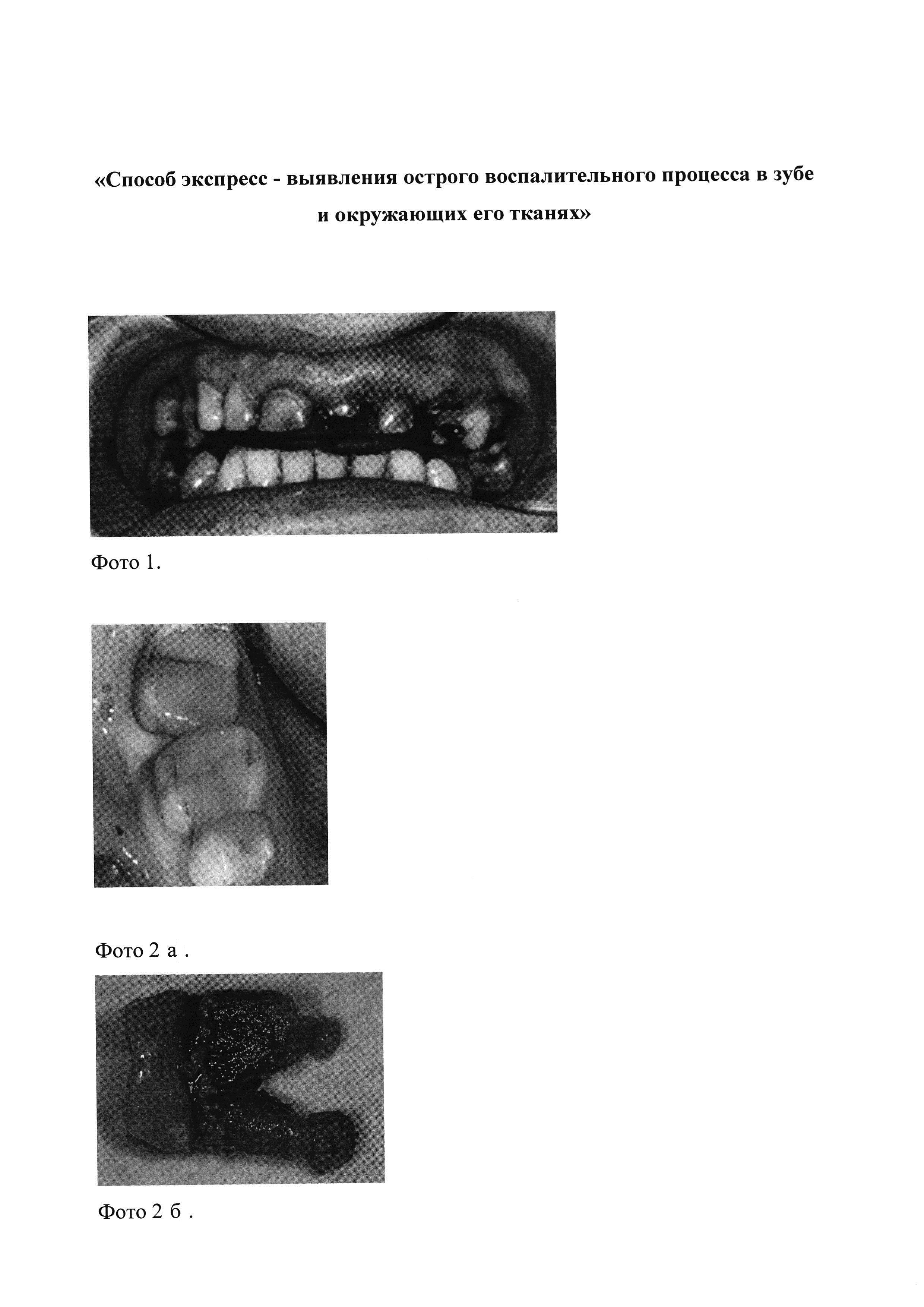 Способ экспресс-выявления острого воспалительного процесса в зубе и окружающих его тканях