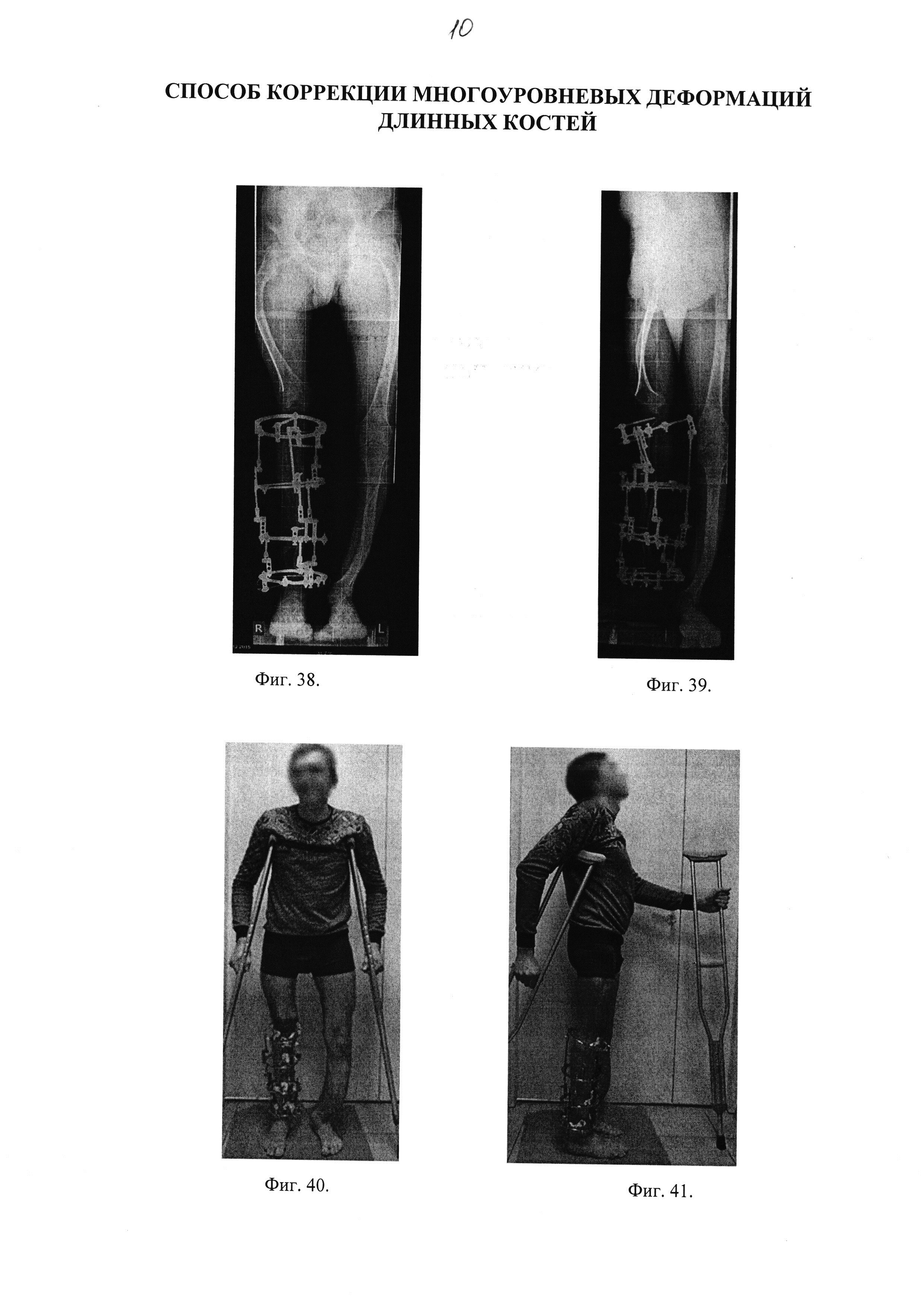 Способ коррекции многоуровневых деформаций длинных костей