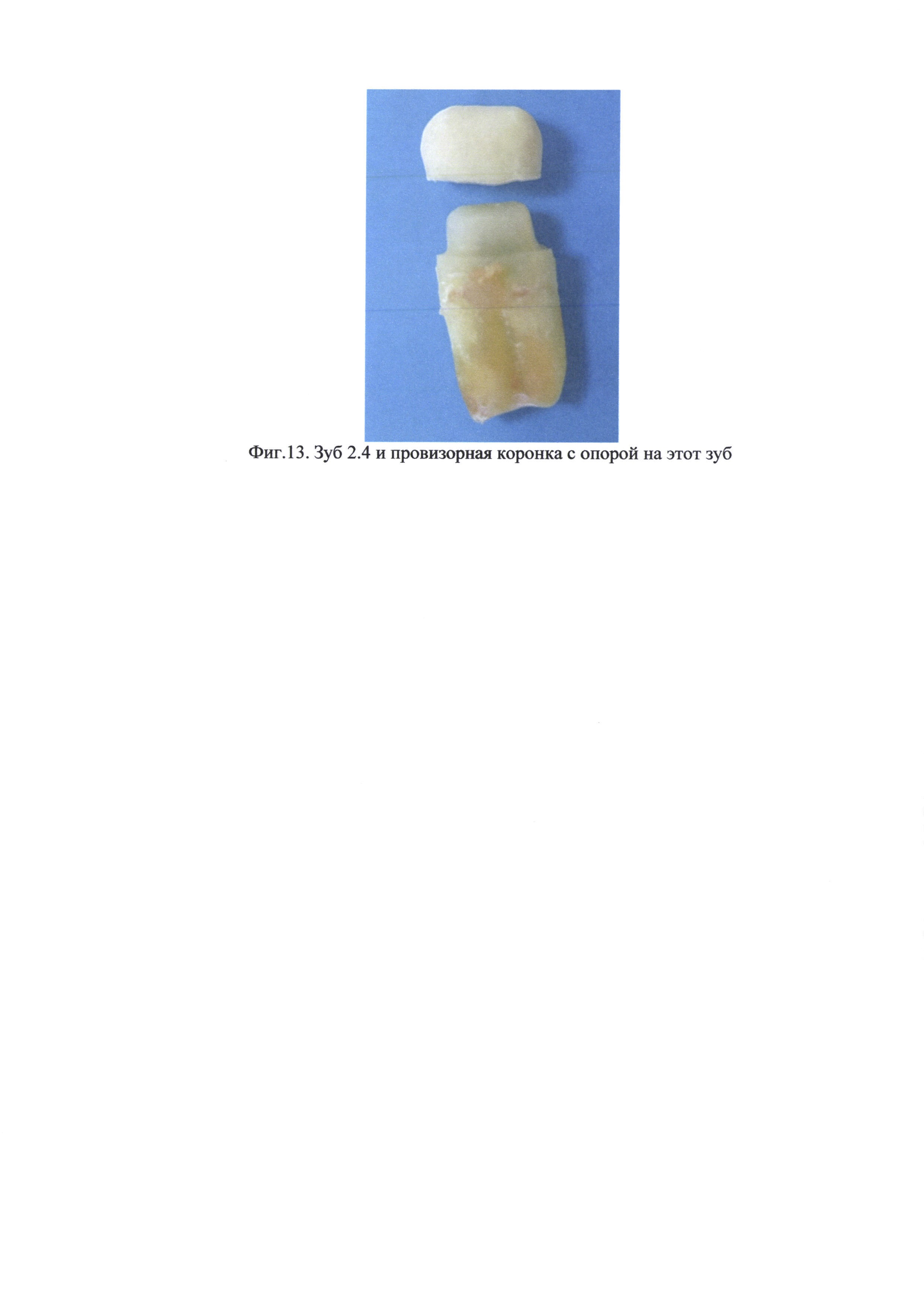 Способ внеротового одонтопрепарирования и изготовления провизорной коронки на реплантируемый зуб