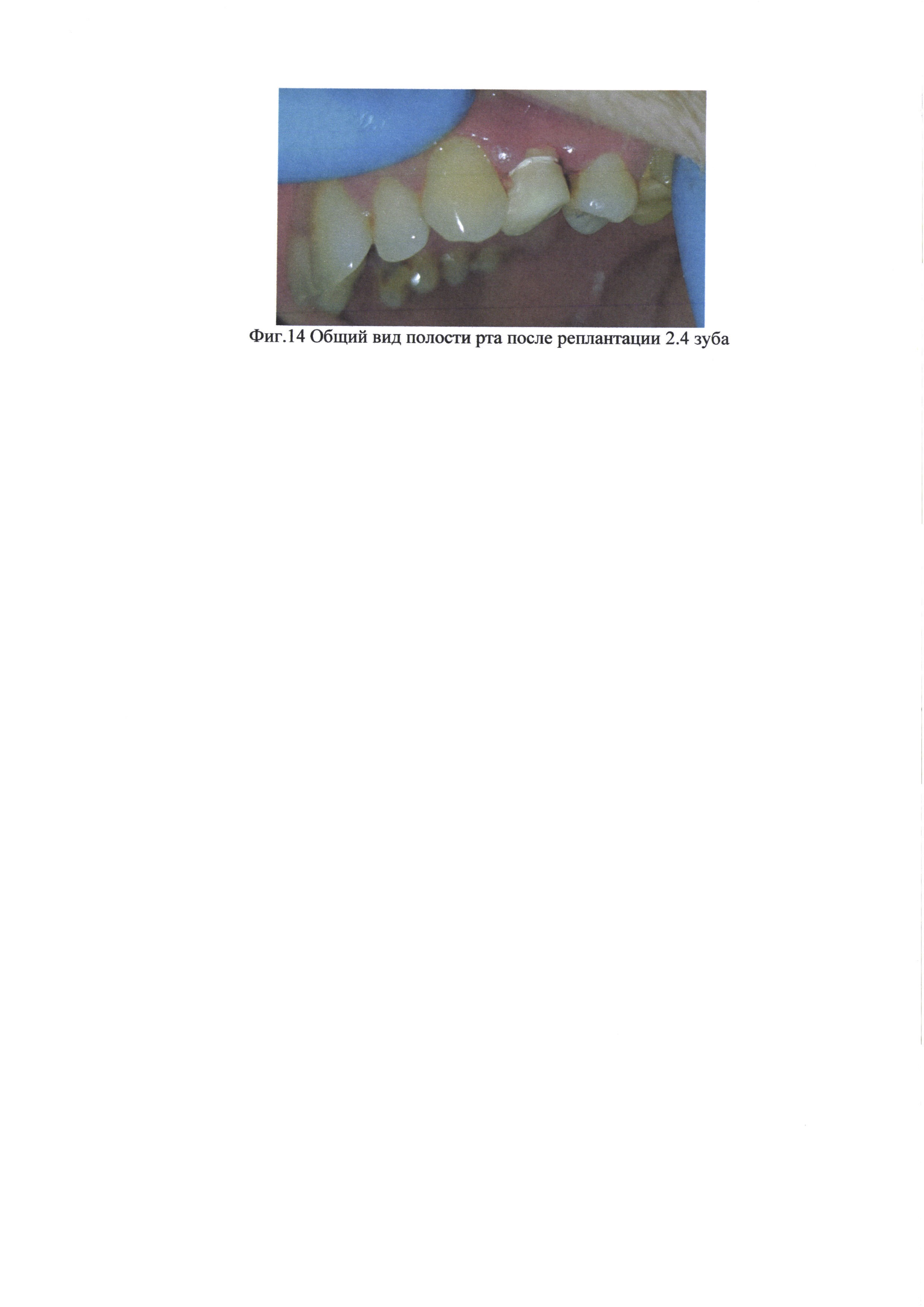 Способ внеротового одонтопрепарирования и изготовления провизорной коронки на реплантируемый зуб