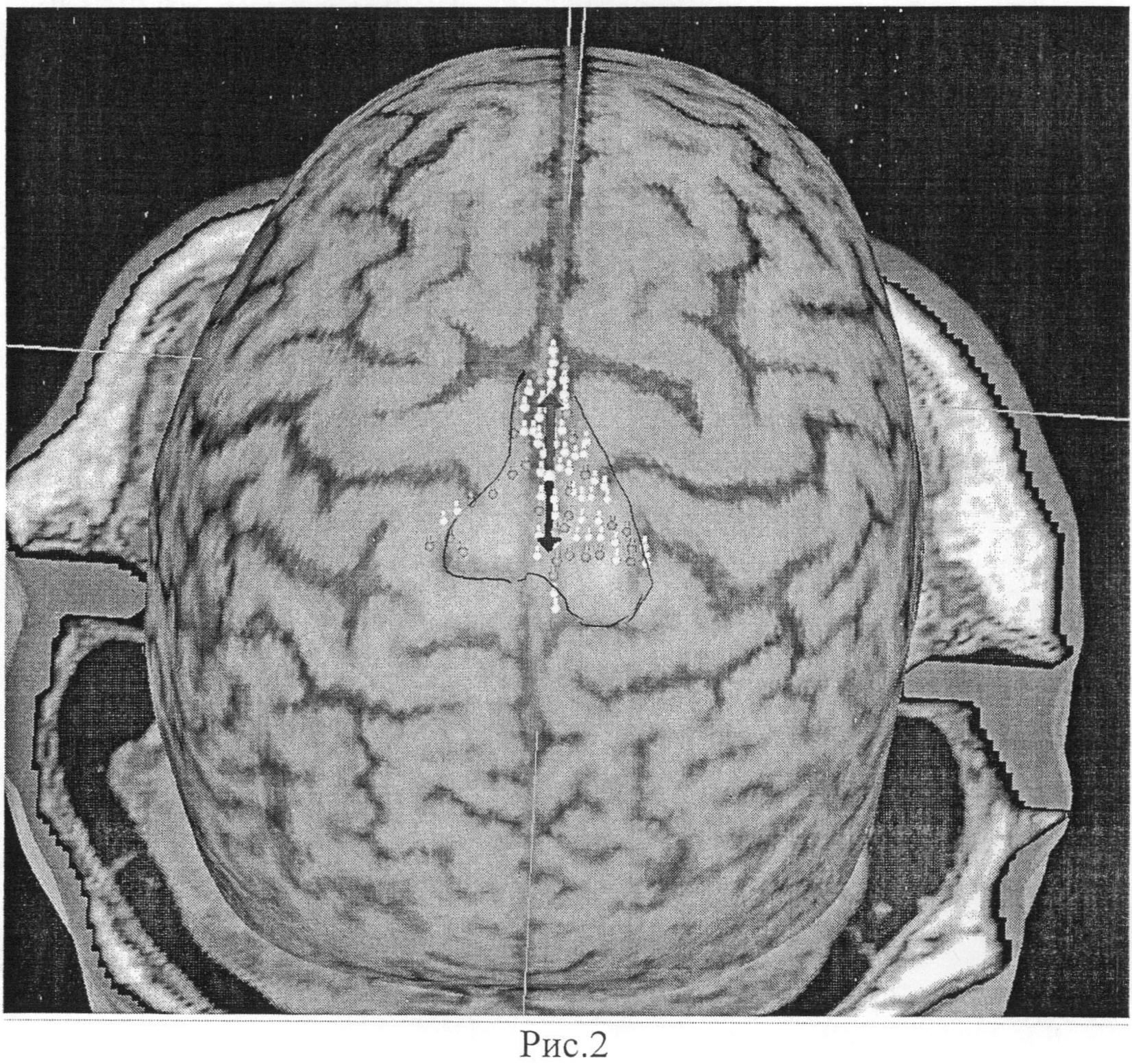 Процесс торможения в коре головного мозга. Раздражение коры головного мозга. Корковые аномалии мозга.