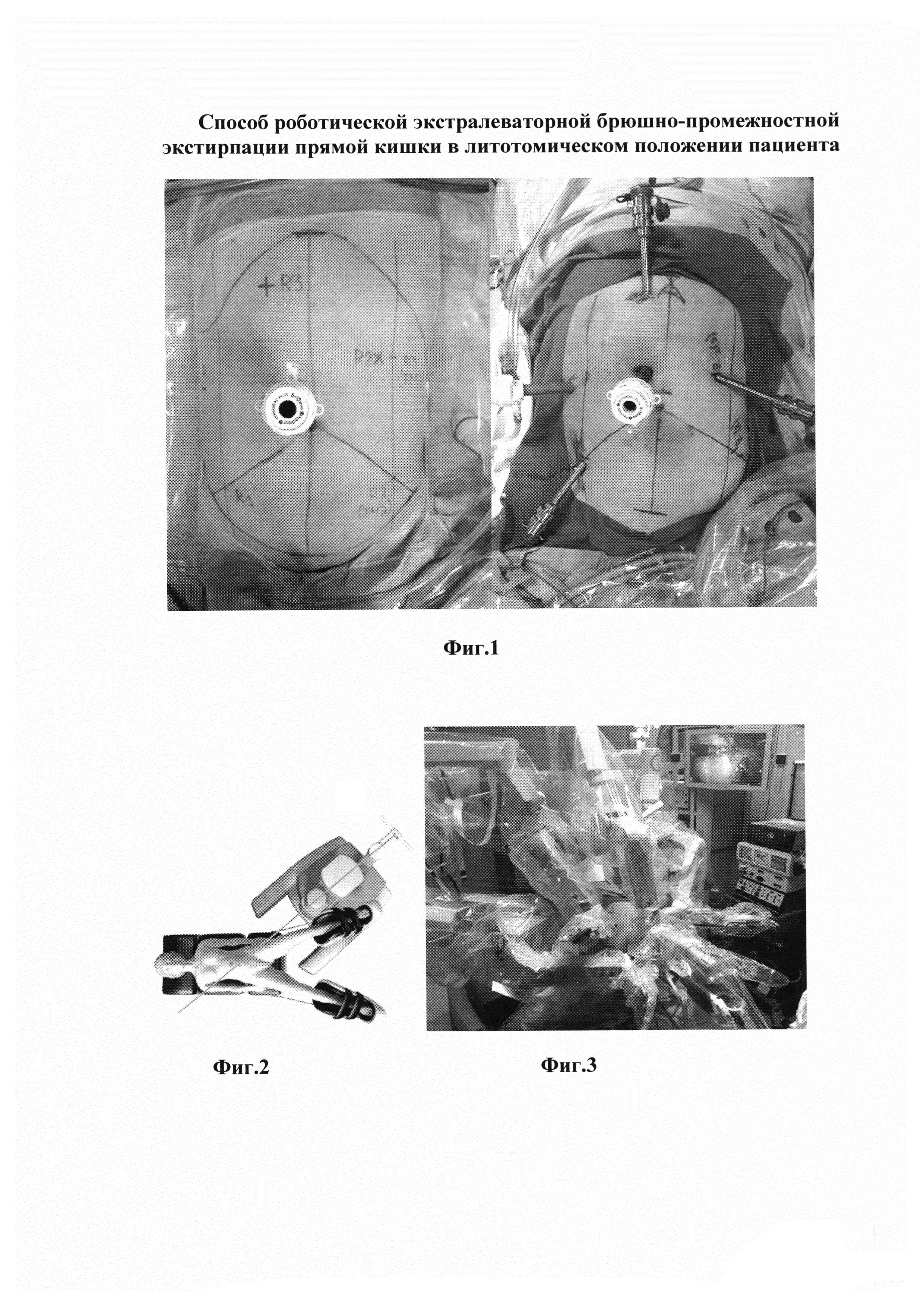 Способ роботической экстралеваторной брюшно-промежностной экстирпации прямой кишки с трансабдоминальным пересечением леваторов в литотомическом положении пациента