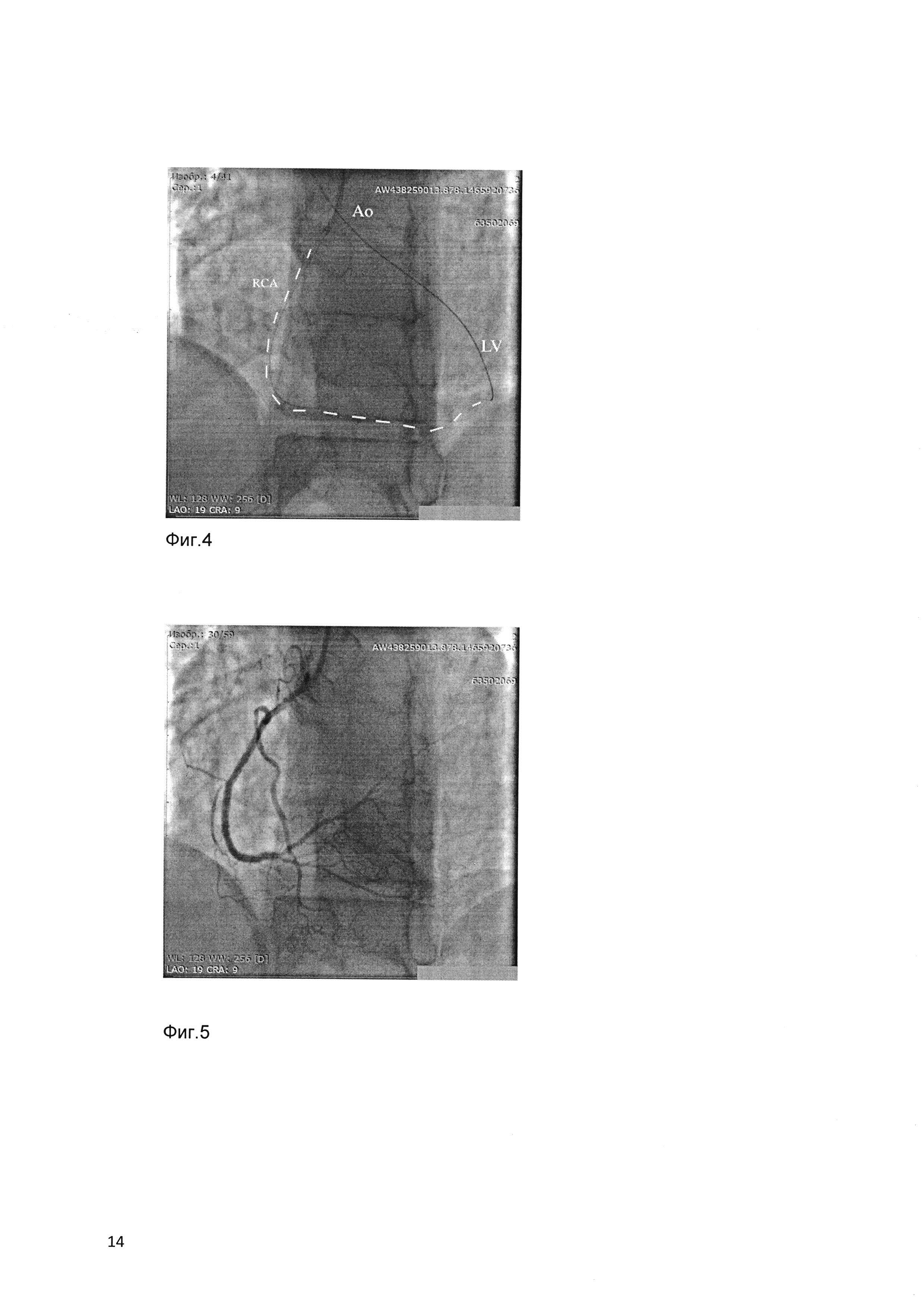 Коронарный проводник и способ стентирования сложных поражений коронарных артерий с его использованием