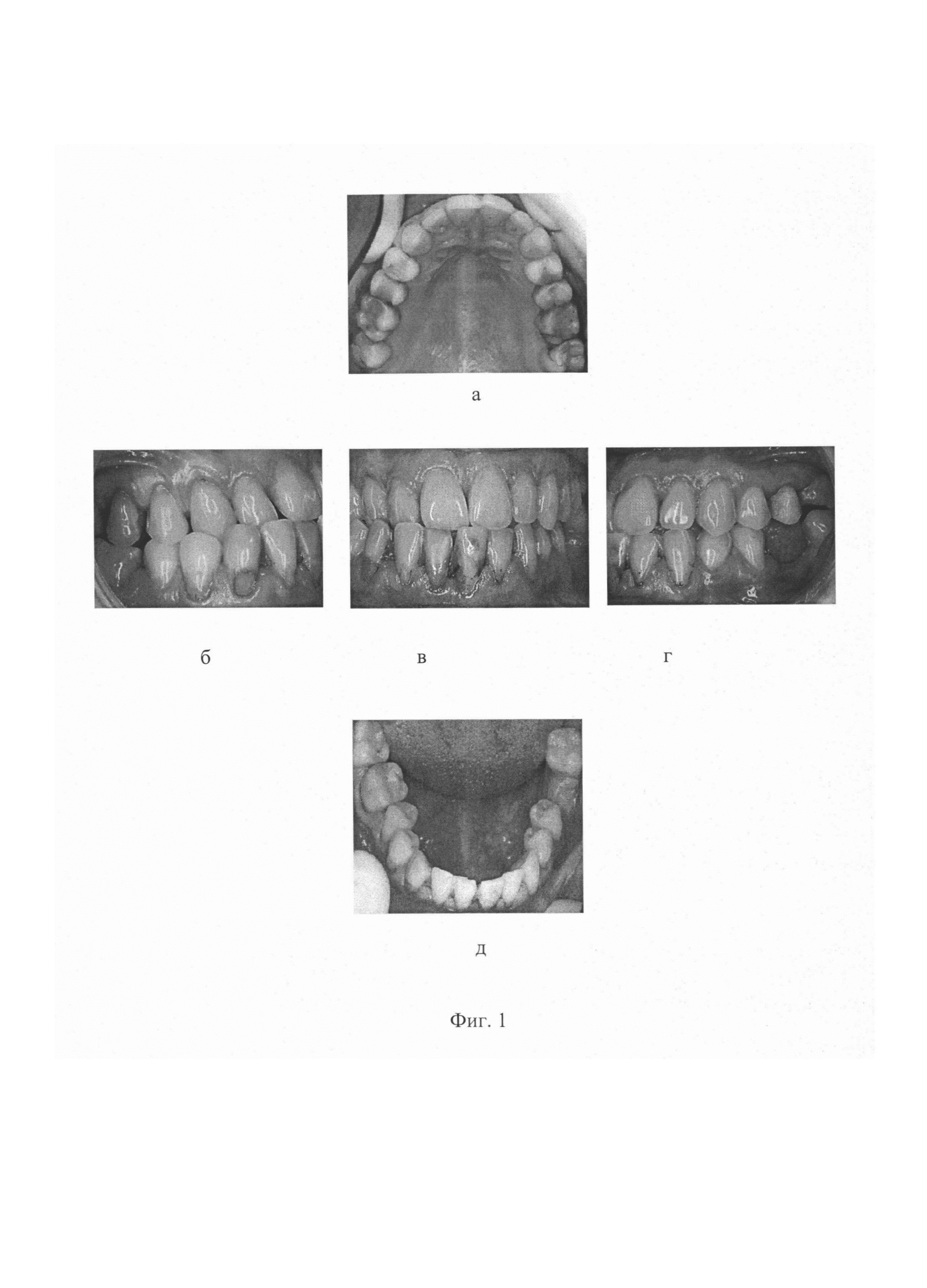 Способ лечения скелетных форм мезиального соотношения зубных рядов у пациентов с завершенным ростом лица