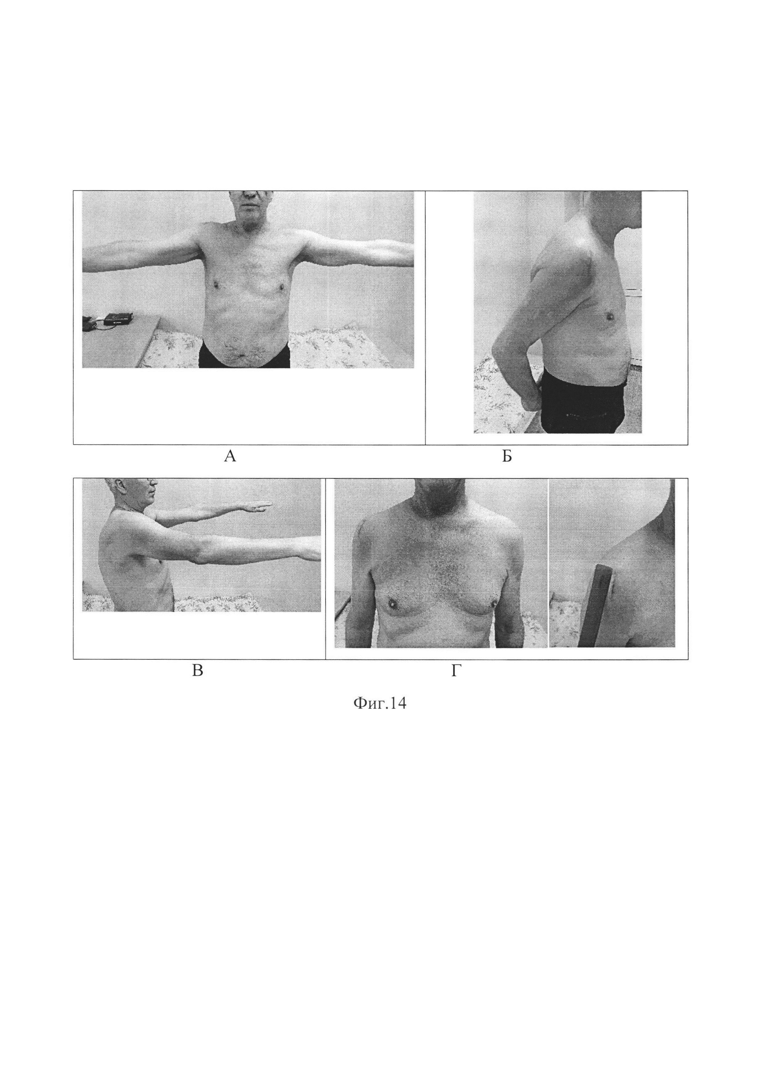 Способ реконструкции вращательной манжеты плечевого сустава при массивных невосстановимых повреждениях, сопровождающихся артропатией
