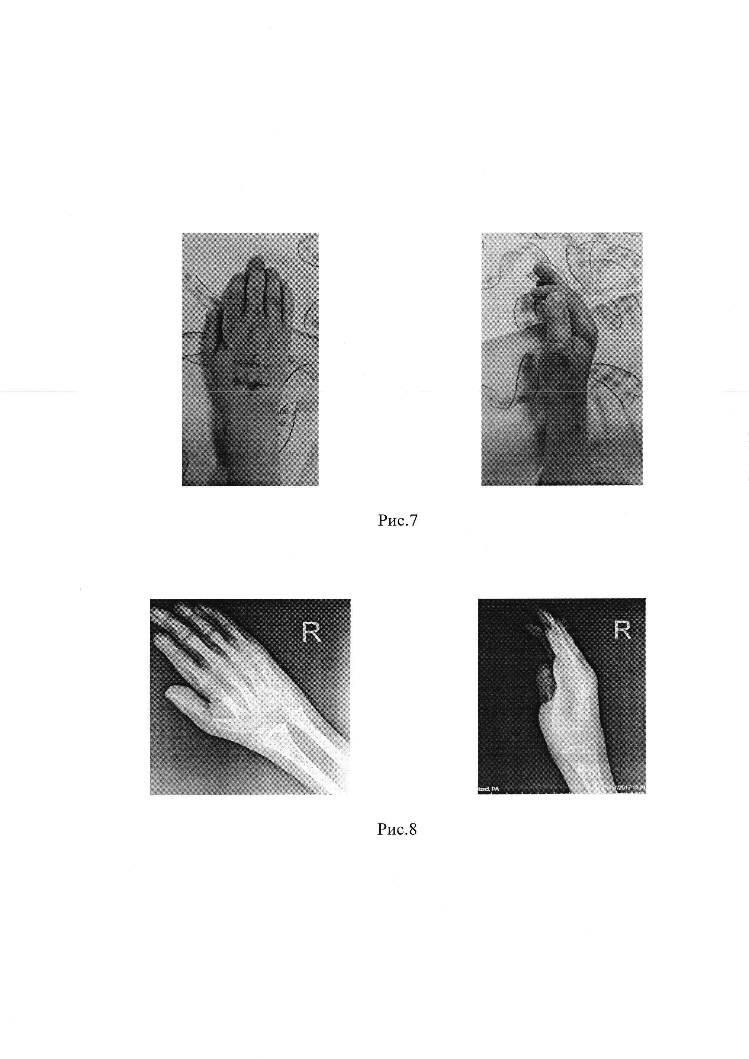 Способ одновременной коррекции разгибательной контрактуры лучезапястного сустава тяжелой степени и сгибательных контрактур пястно-фаланговых суставов II-IV пальцев кисти у детей с артрогрипозом