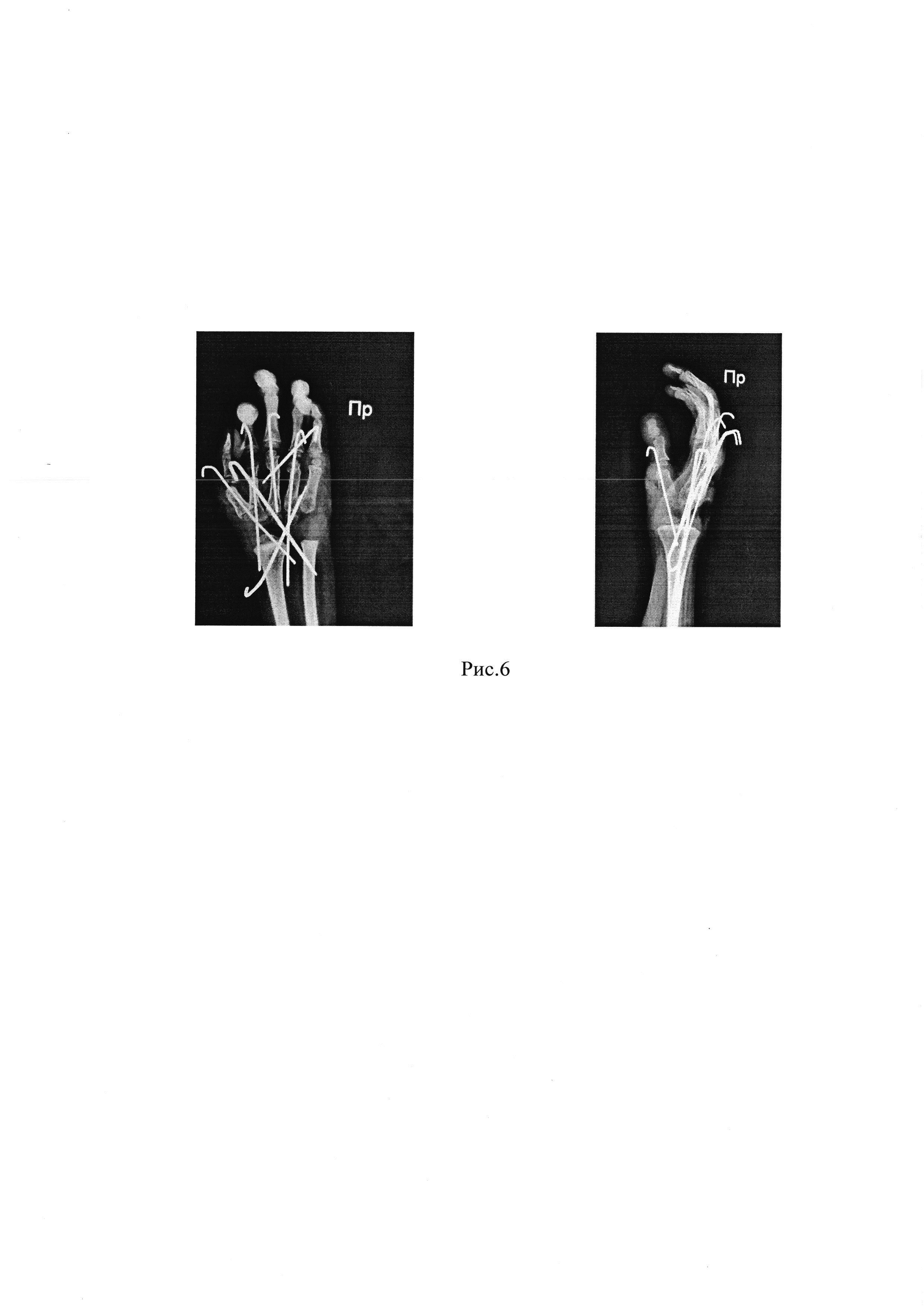Способ одновременной коррекции разгибательной контрактуры лучезапястного сустава тяжелой степени и сгибательных контрактур пястно-фаланговых суставов II-IV пальцев кисти у детей с артрогрипозом