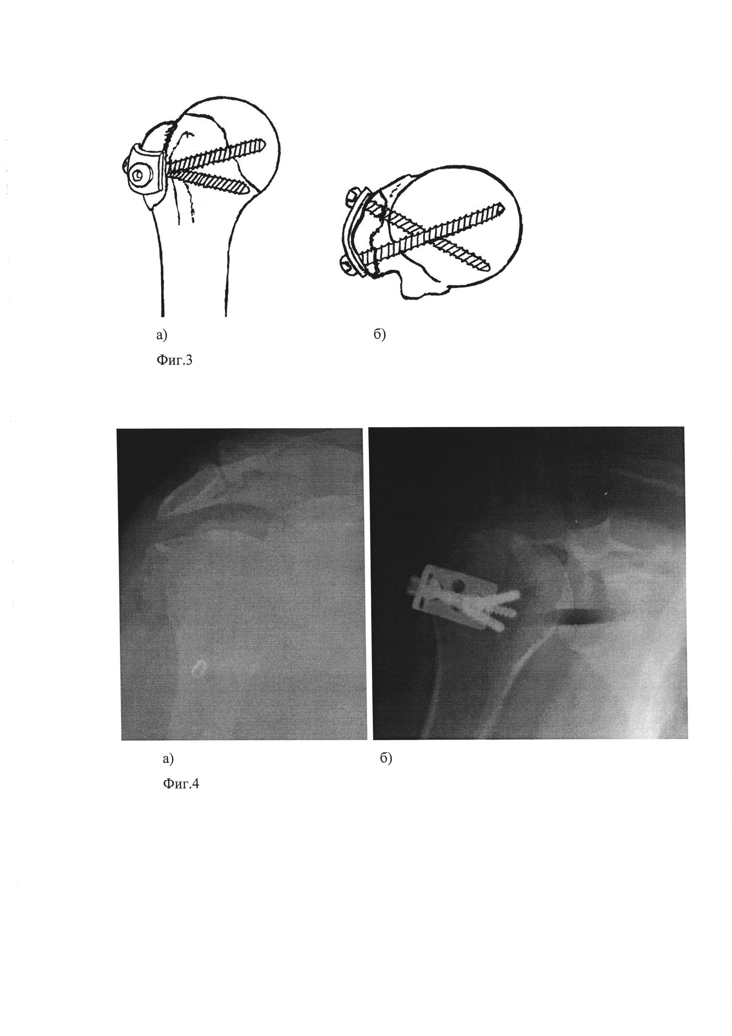 Устройство для лечения переломов большого бугорка плечевой кости